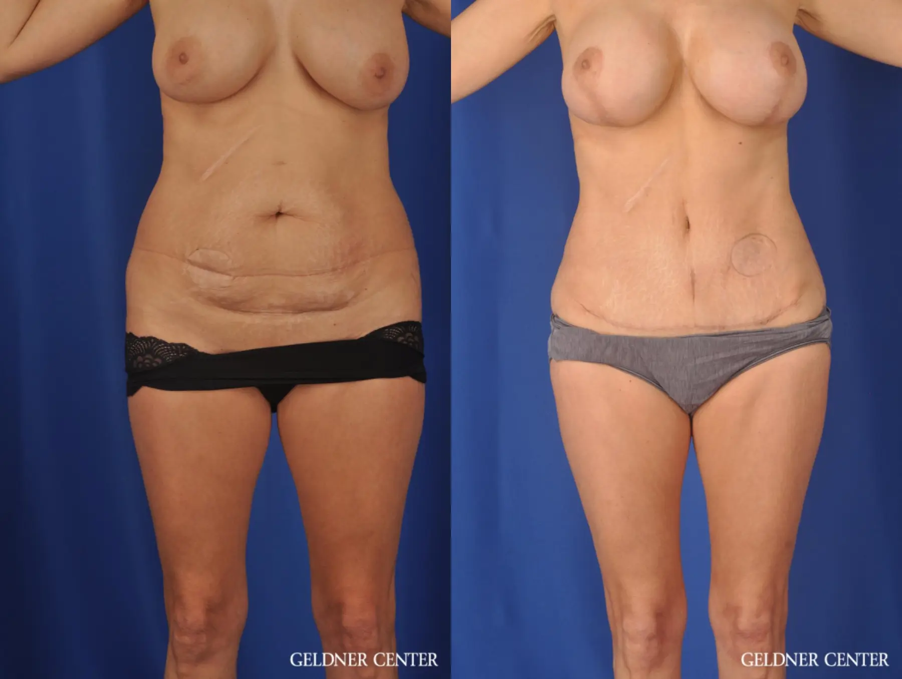 Liposuction: Patient 37 - Before and After 1