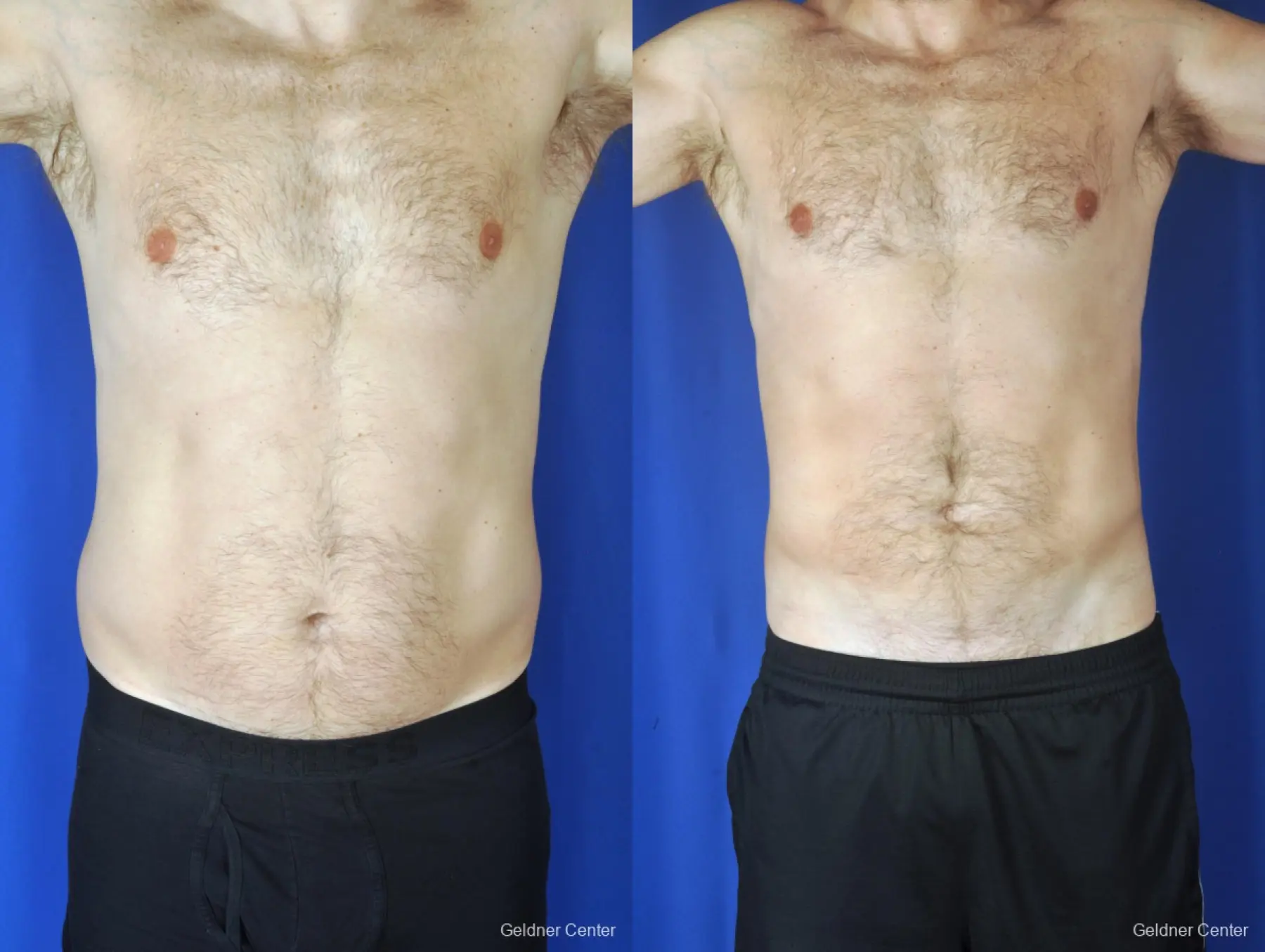 Liposuction For Men: Patient 7 - Before and After 1