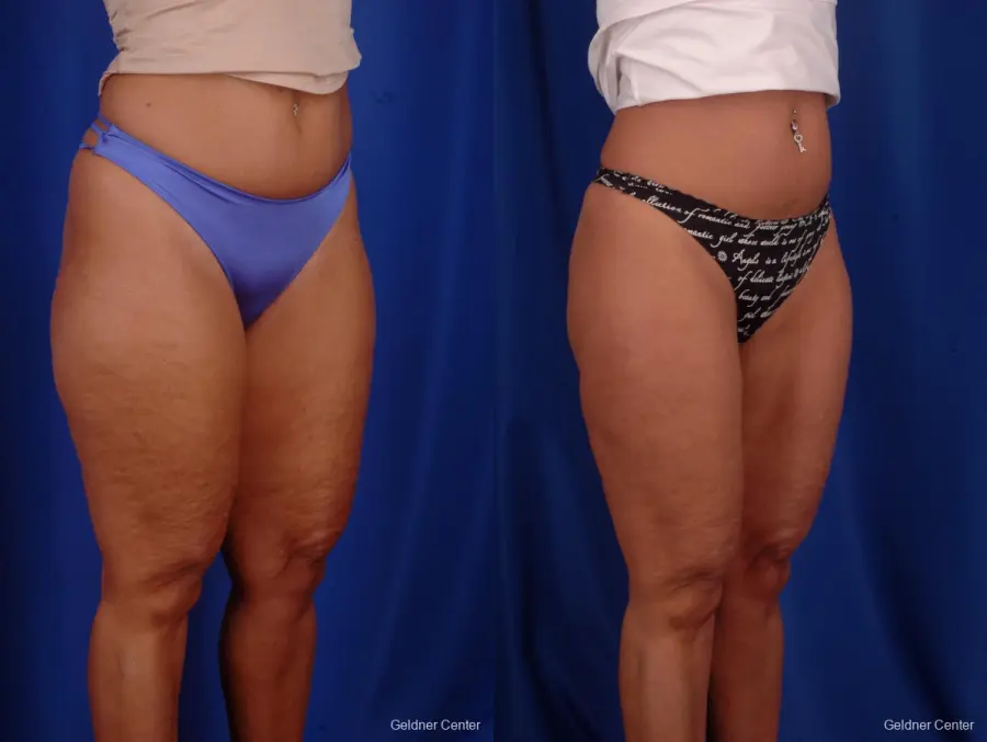 Liposuction: Patient 7 - Before and After 2