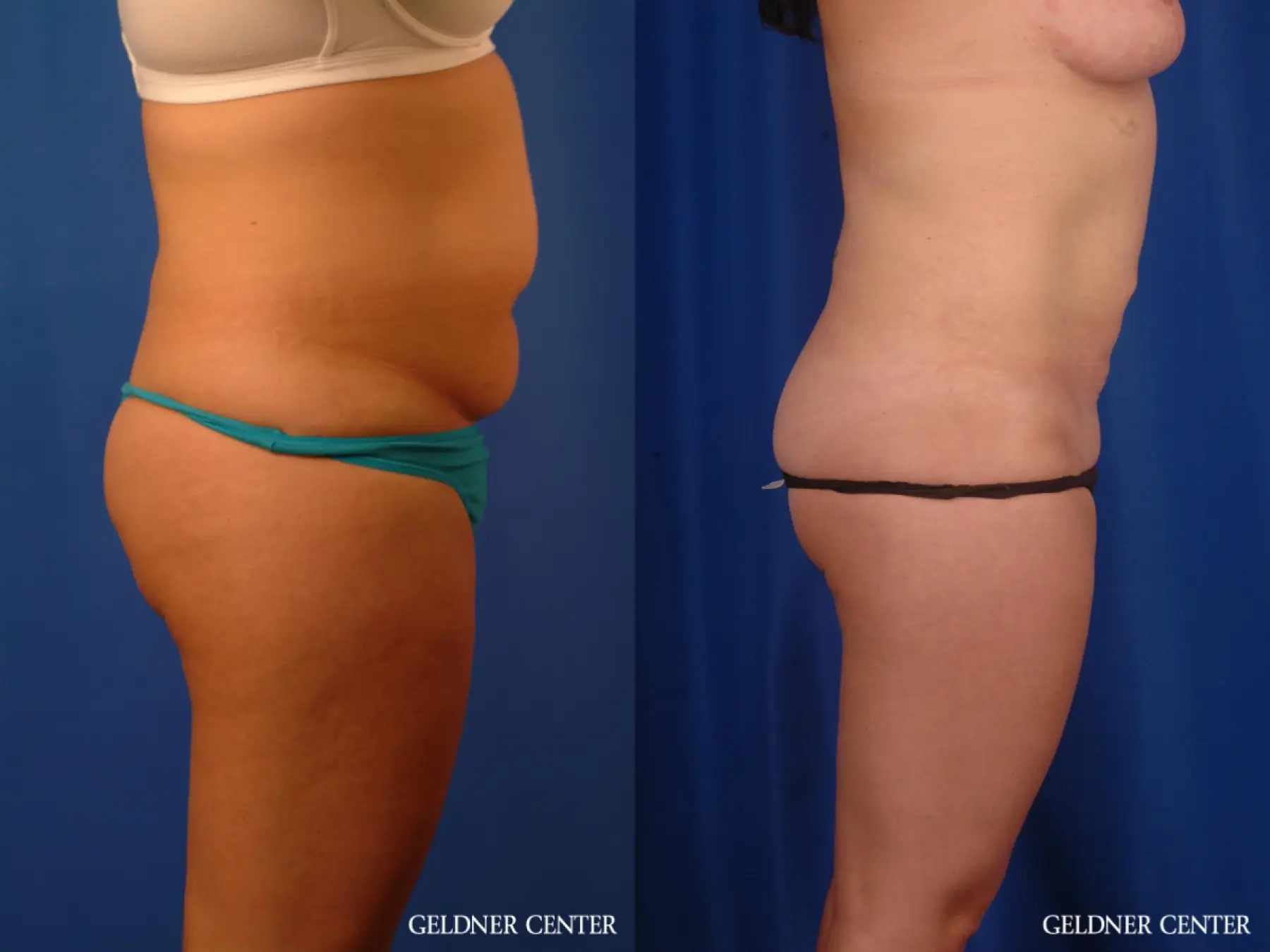 Liposuction: Patient 46 - Before and After 3