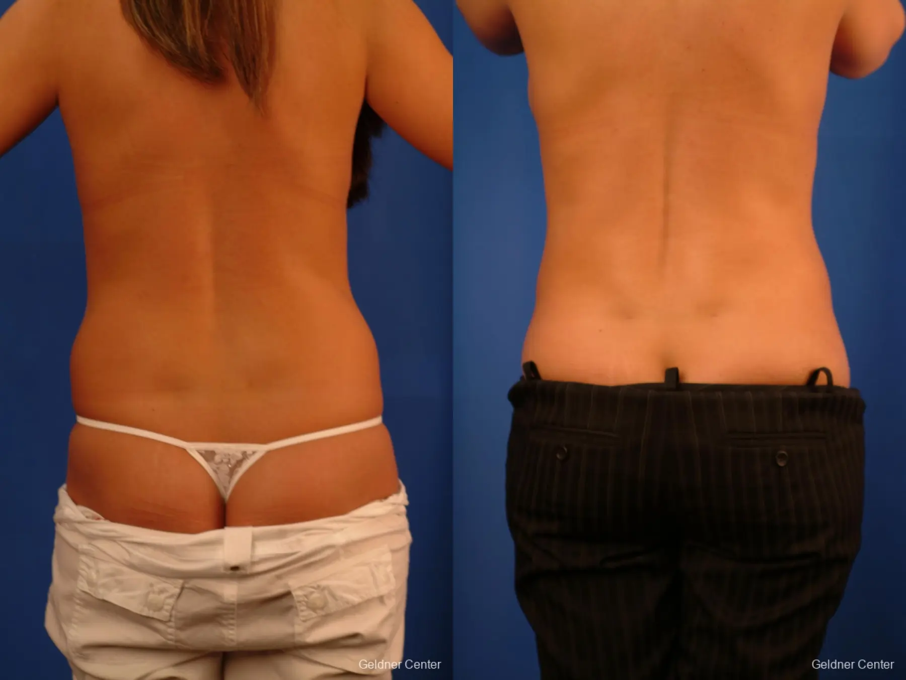 Liposuction: Patient 17 - Before and After 2