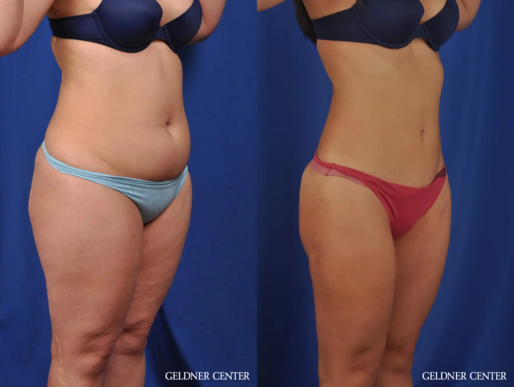 Liposuction: Patient 22 - Before and After 2