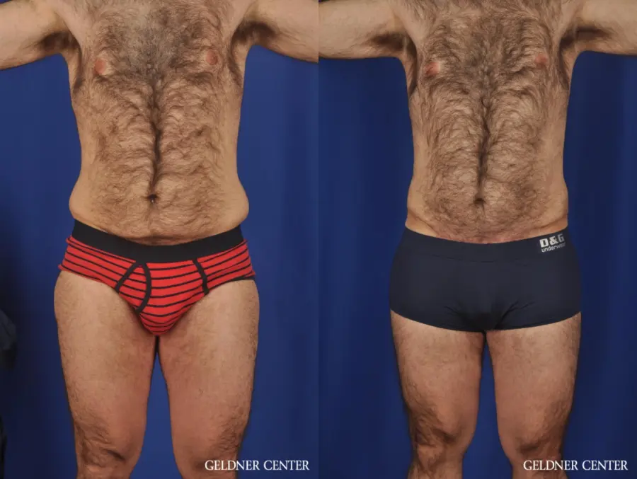 Liposuction-for-men: Patient 10 - Before and After  