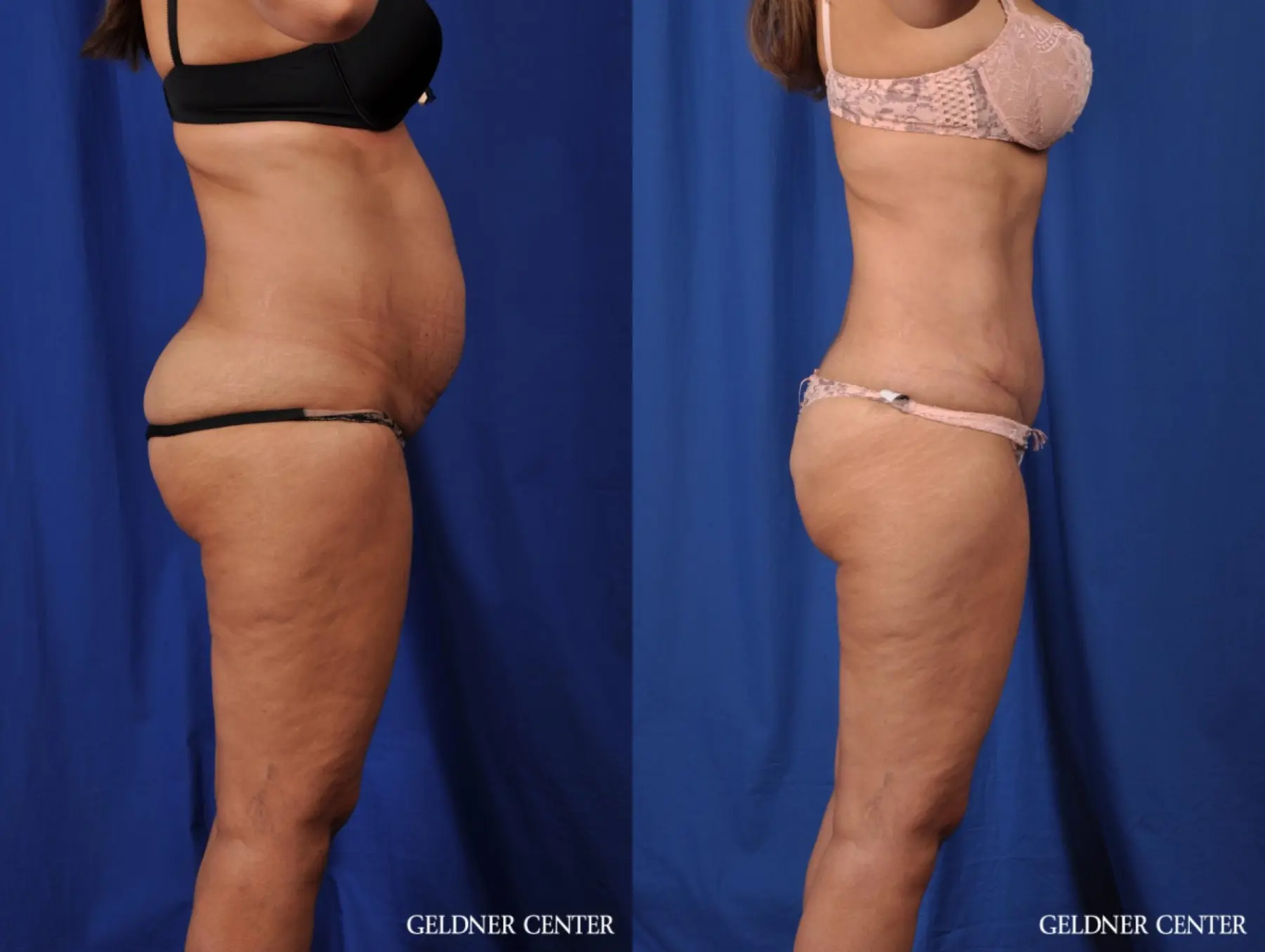 Liposuction: Patient 25 - Before and After 3
