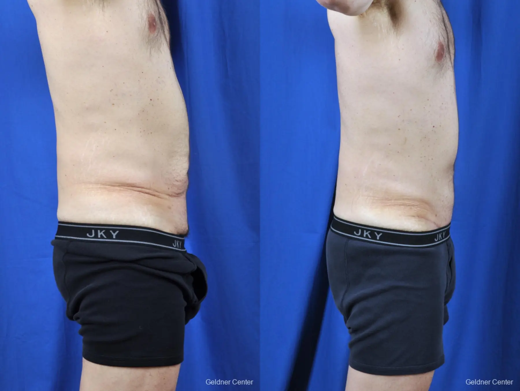 Liposuction For Men: Patient 8 - Before and After 3