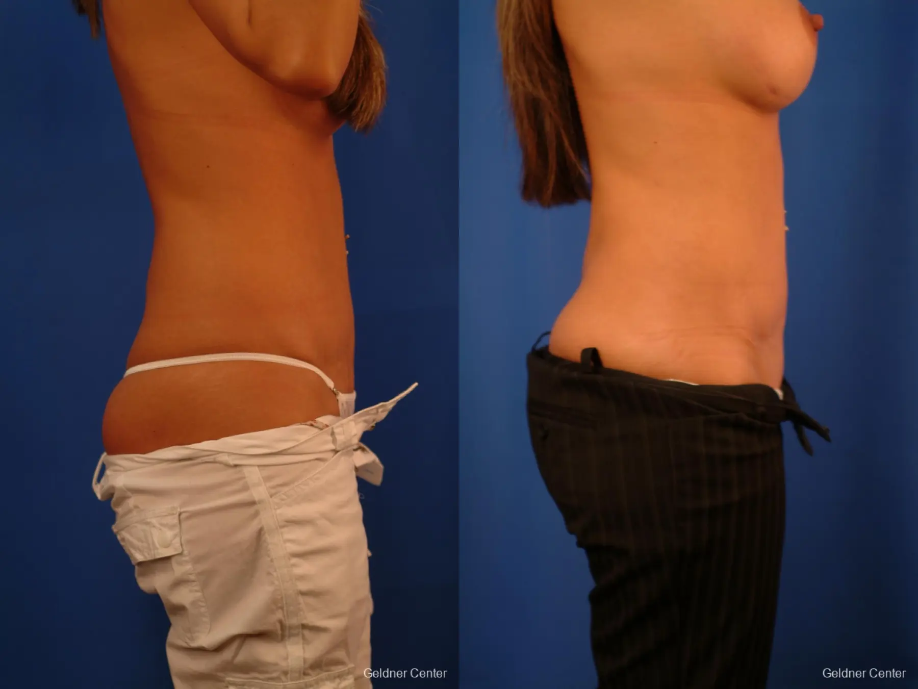 Liposuction: Patient 17 - Before and After 4