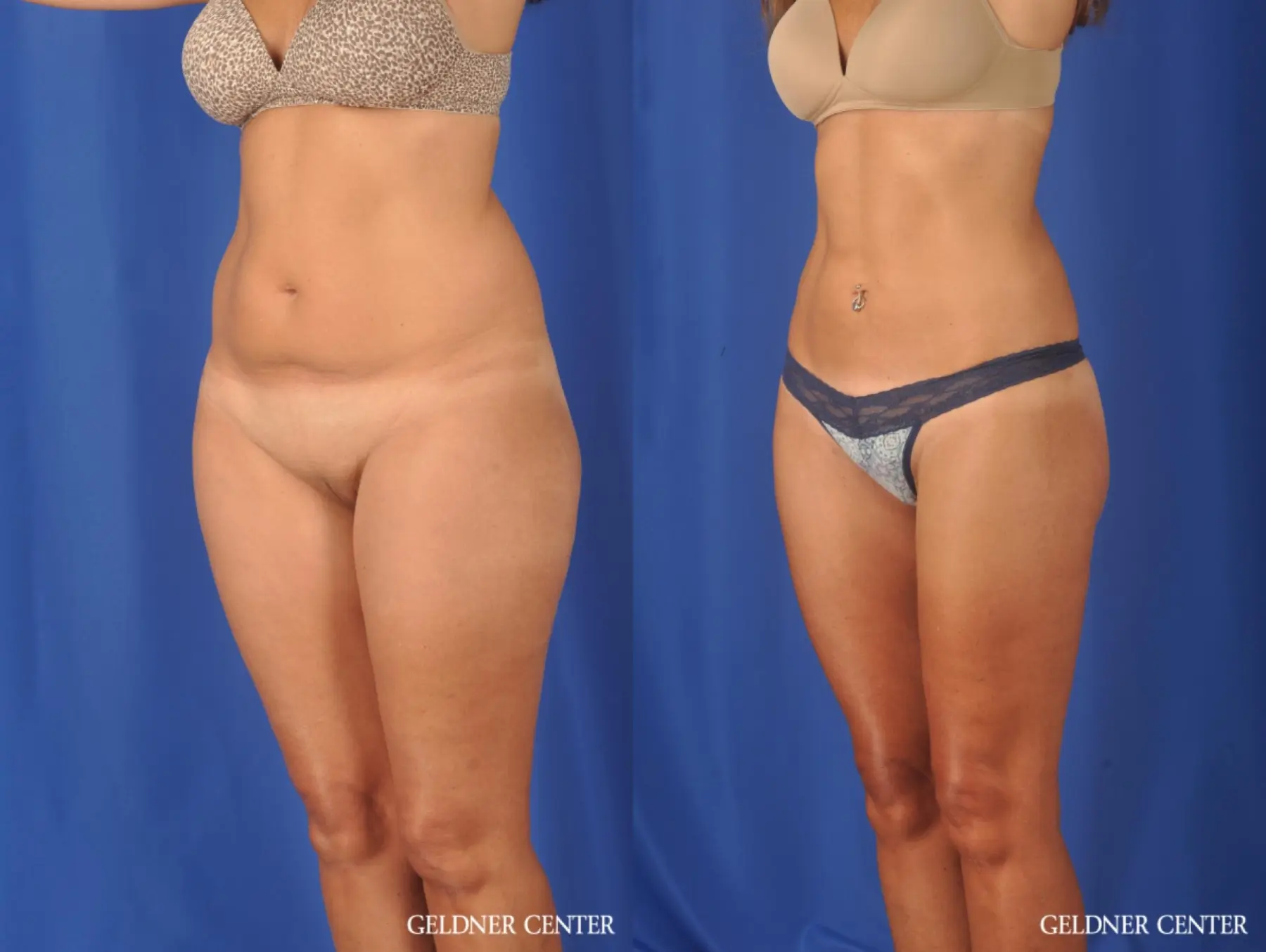 Liposuction: Patient 47 - Before and After 5