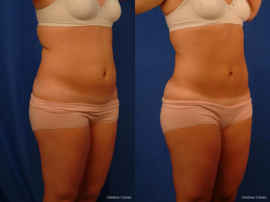 Liposuction: Patient 12 - Before and After 2