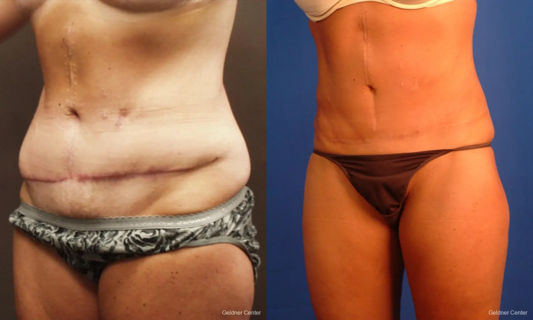 Liposuction: Patient 16 - Before and After 4
