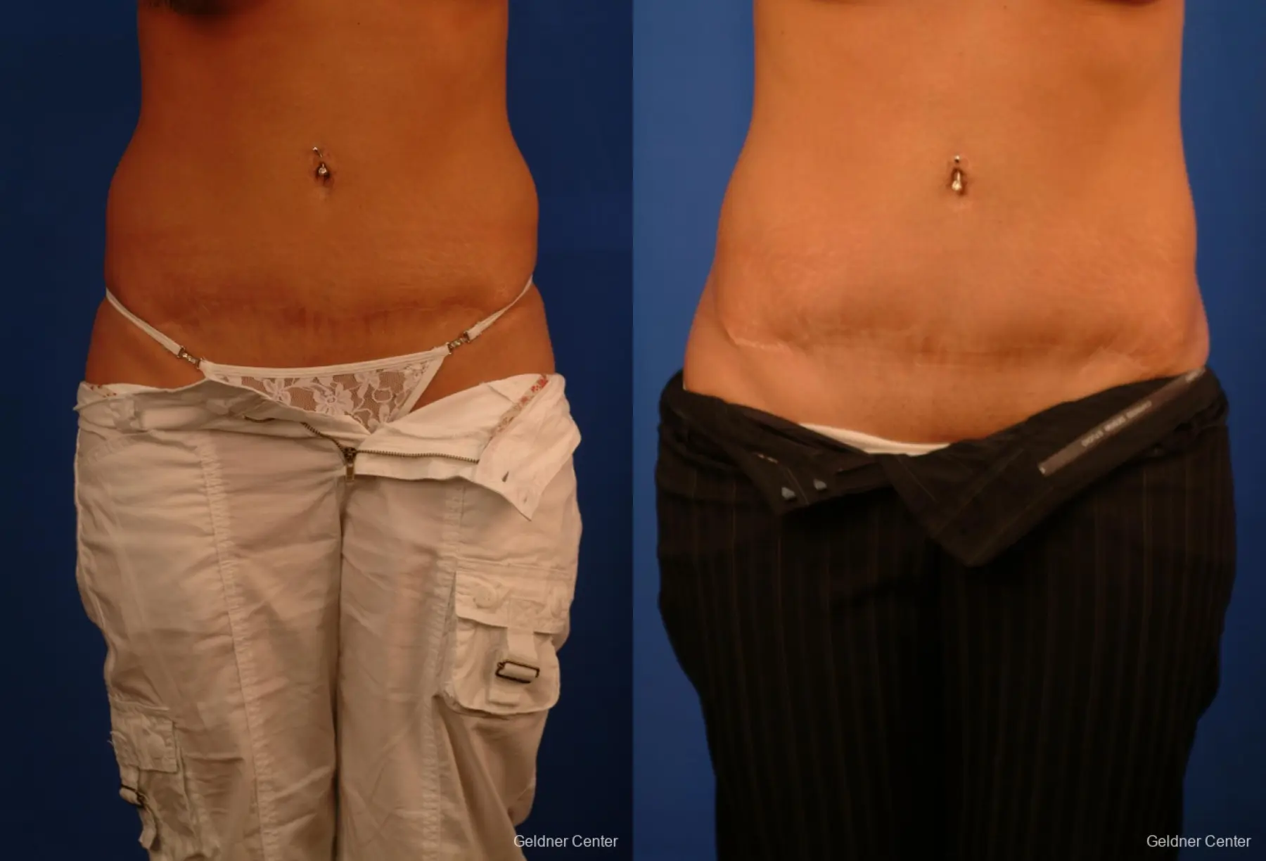 Liposuction: Patient 17 - Before and After  