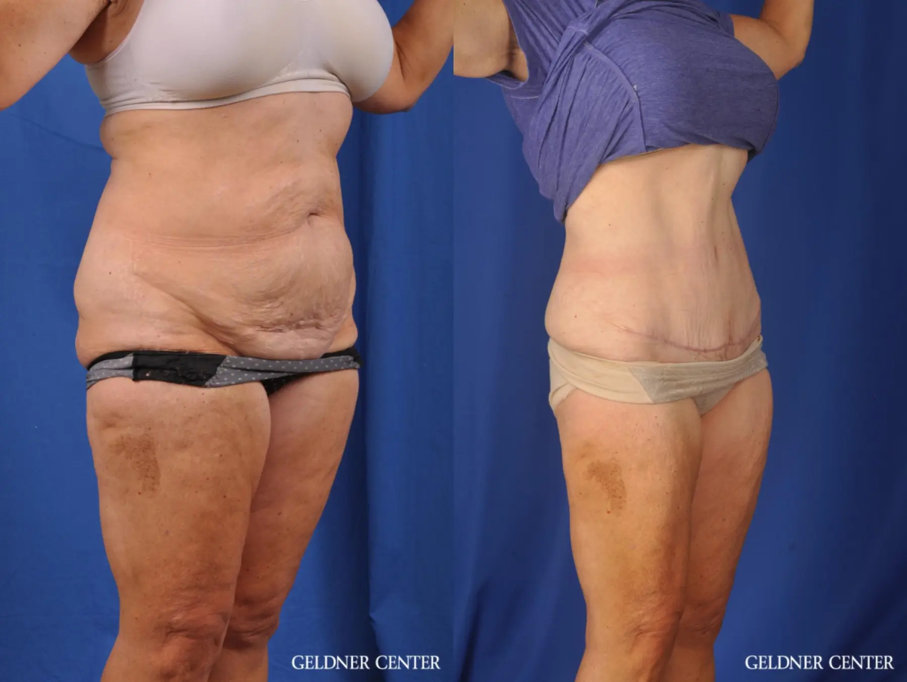 Liposuction: Patient 34 - Before and After 2