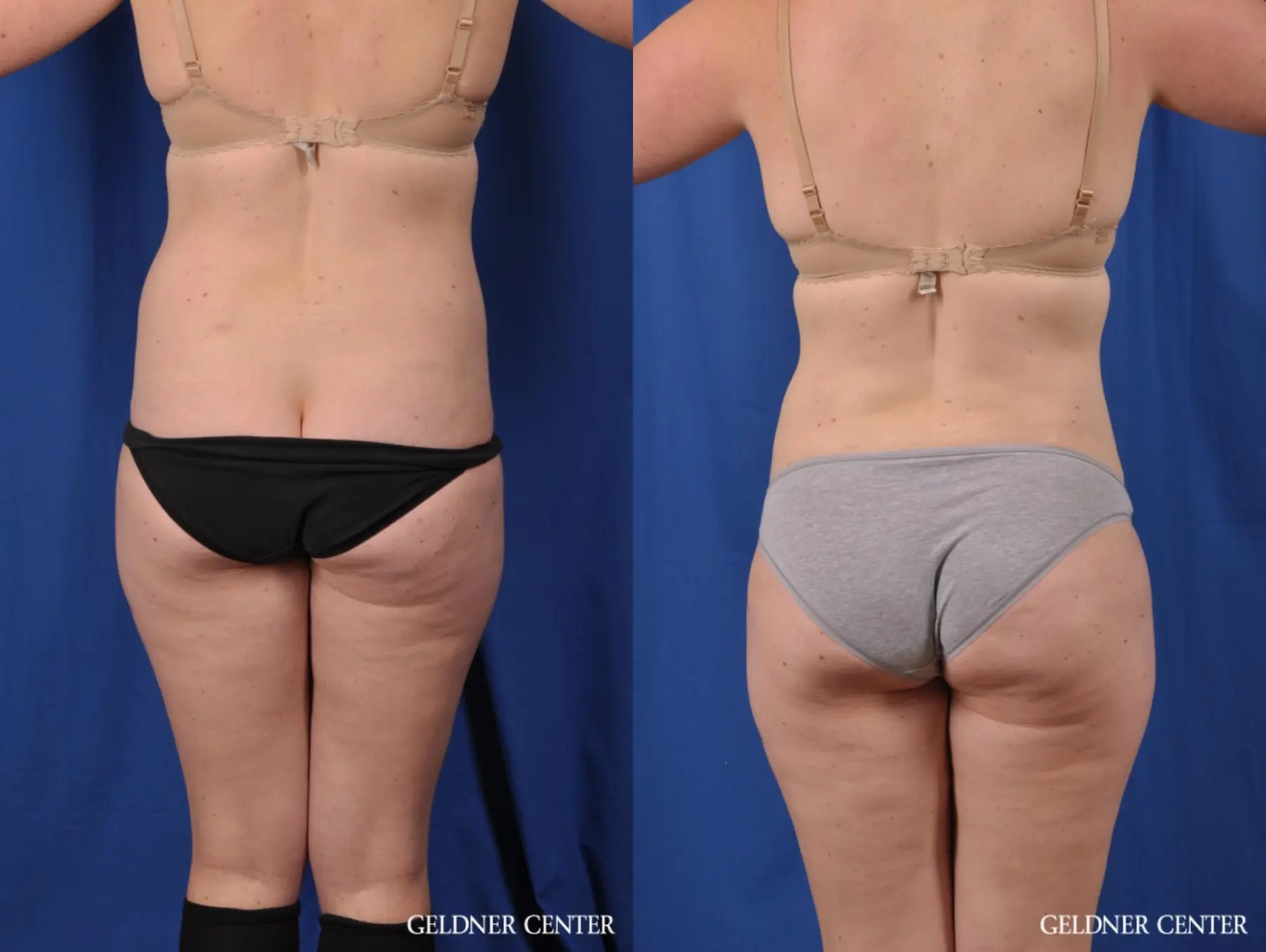 Liposuction: Patient 48 - Before and After 4