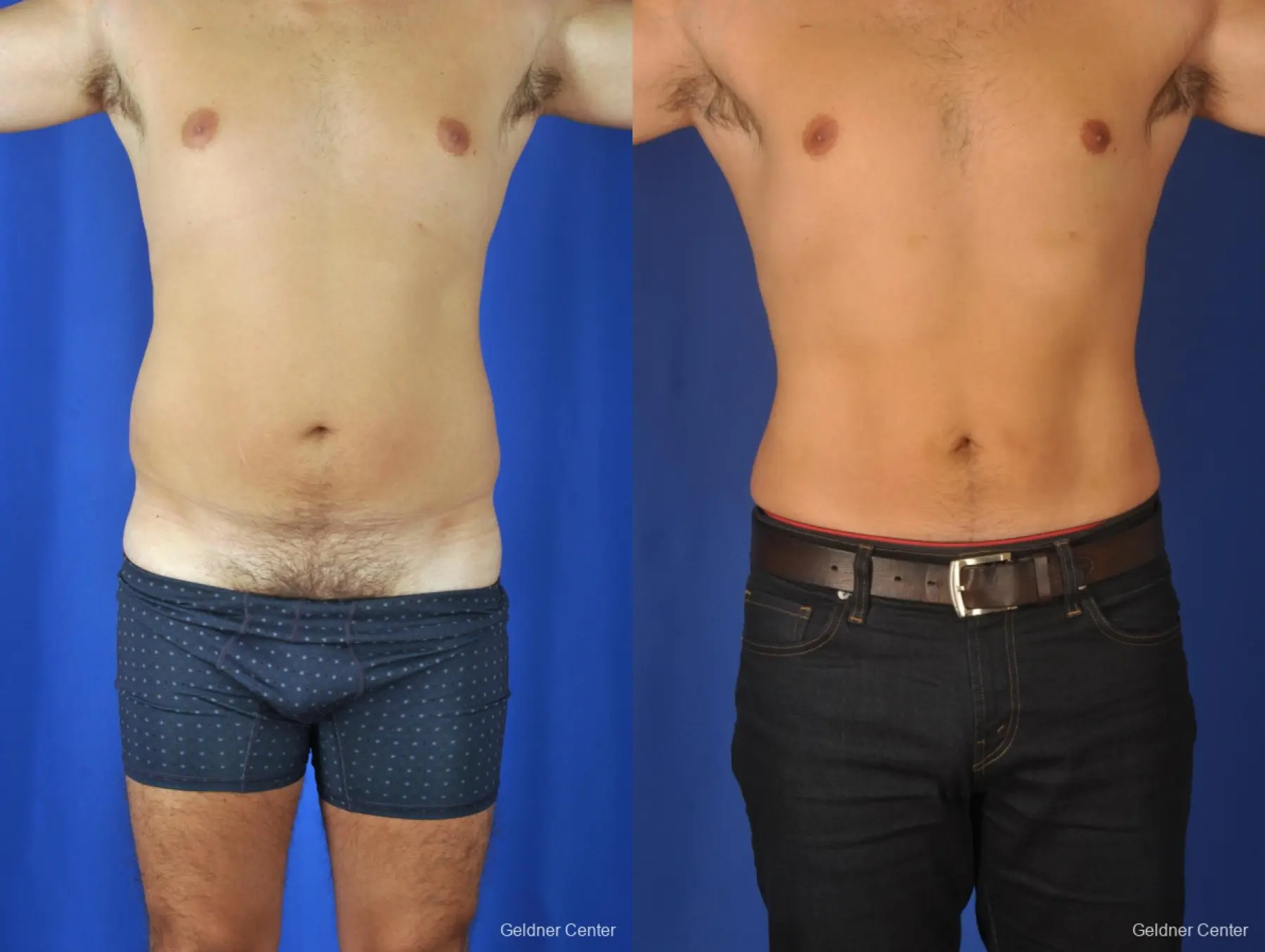 Liposuction For Men: Patient 4 - Before and After 1