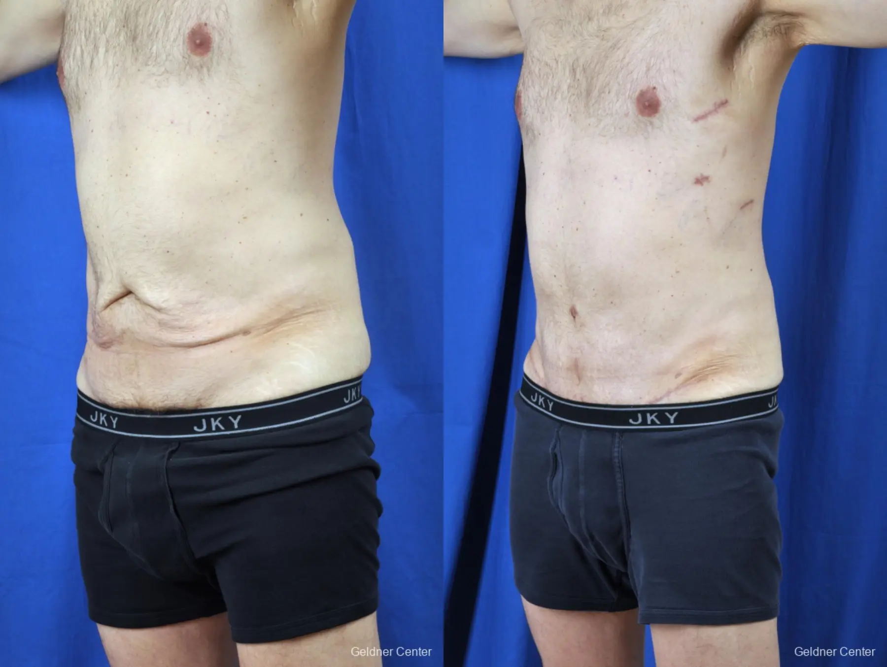 Liposuction For Men: Patient 8 - Before and After 4
