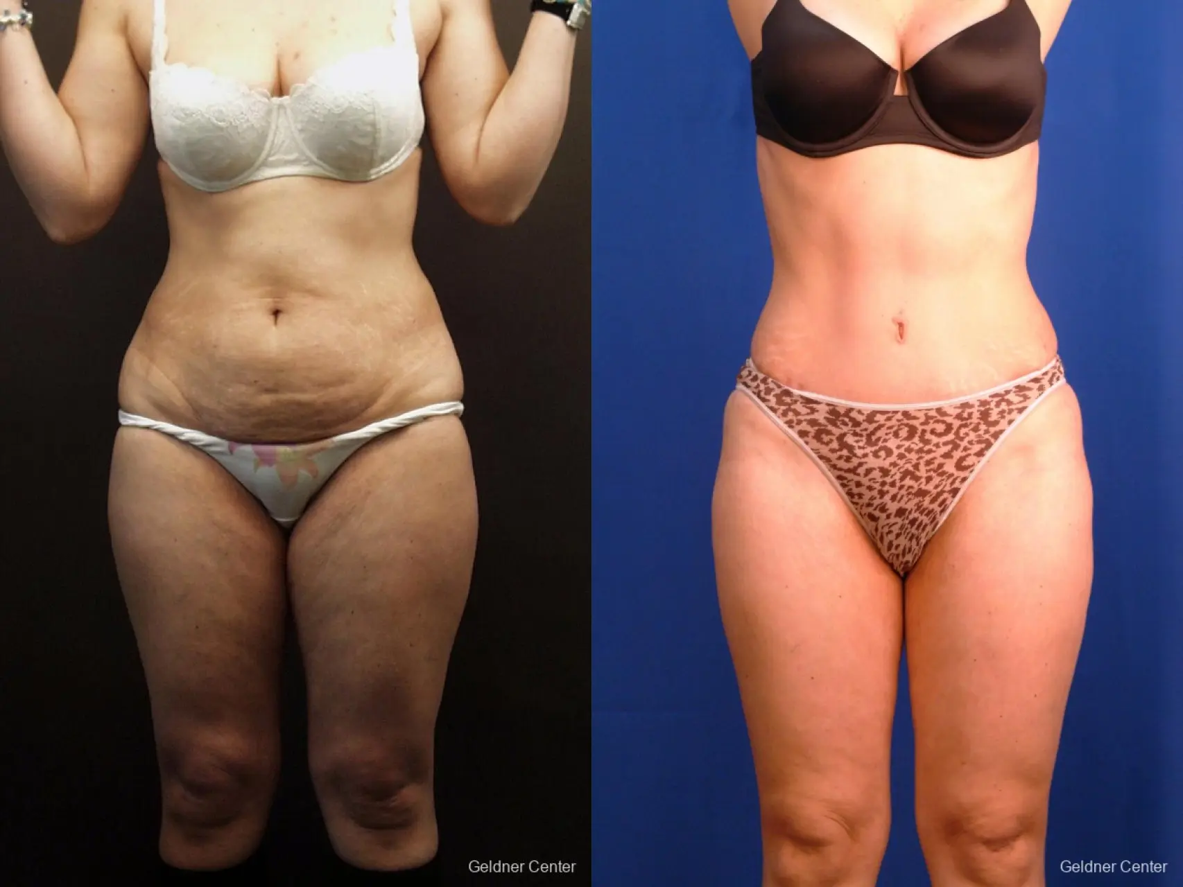 Liposuction: Patient 9 - Before and After  