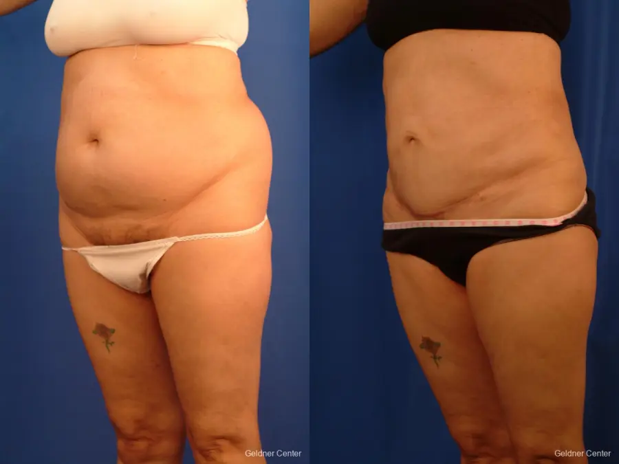 Liposuction: Patient 18 - Before and After 4