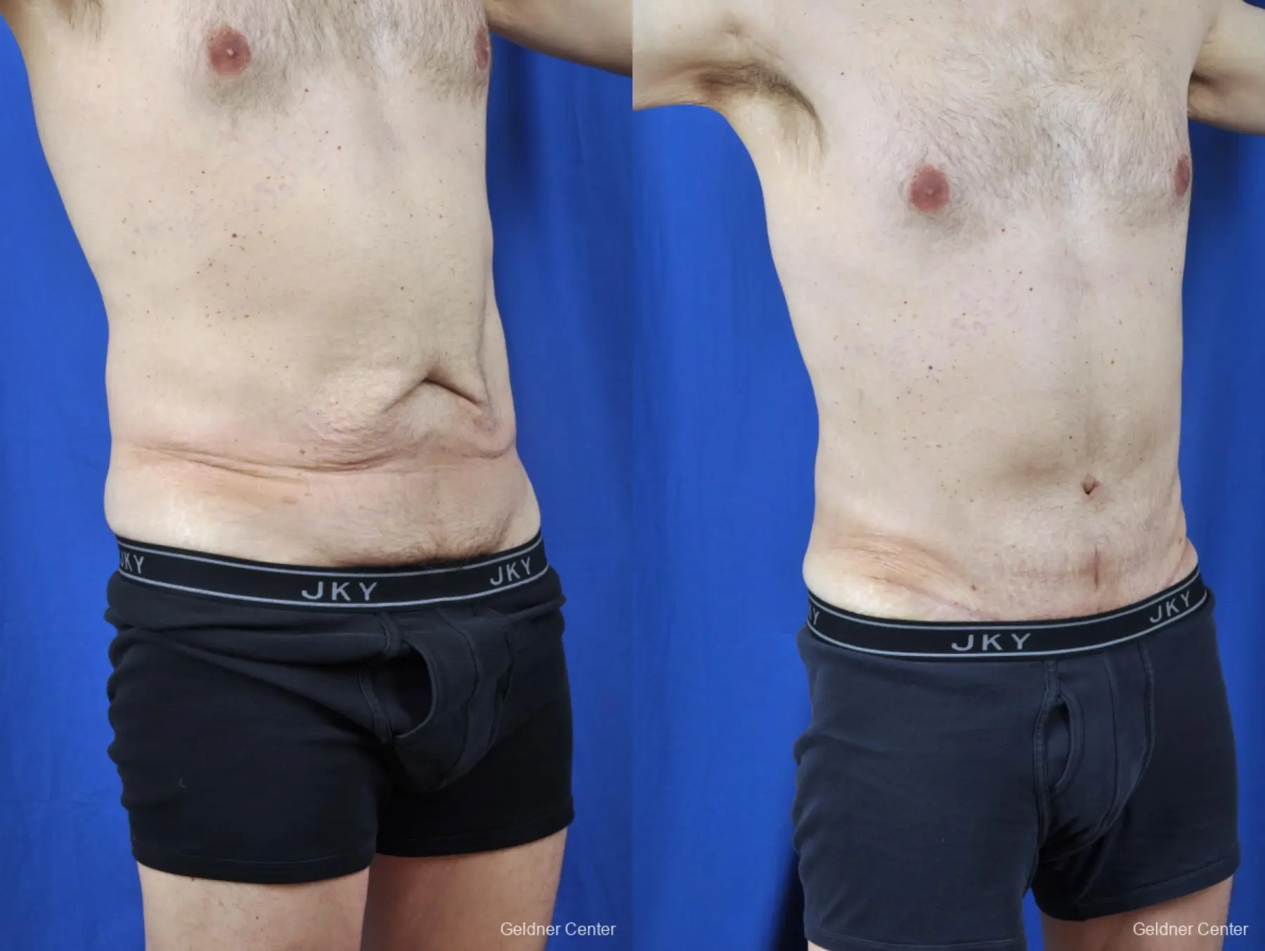 Liposuction For Men: Patient 8 - Before and After 2