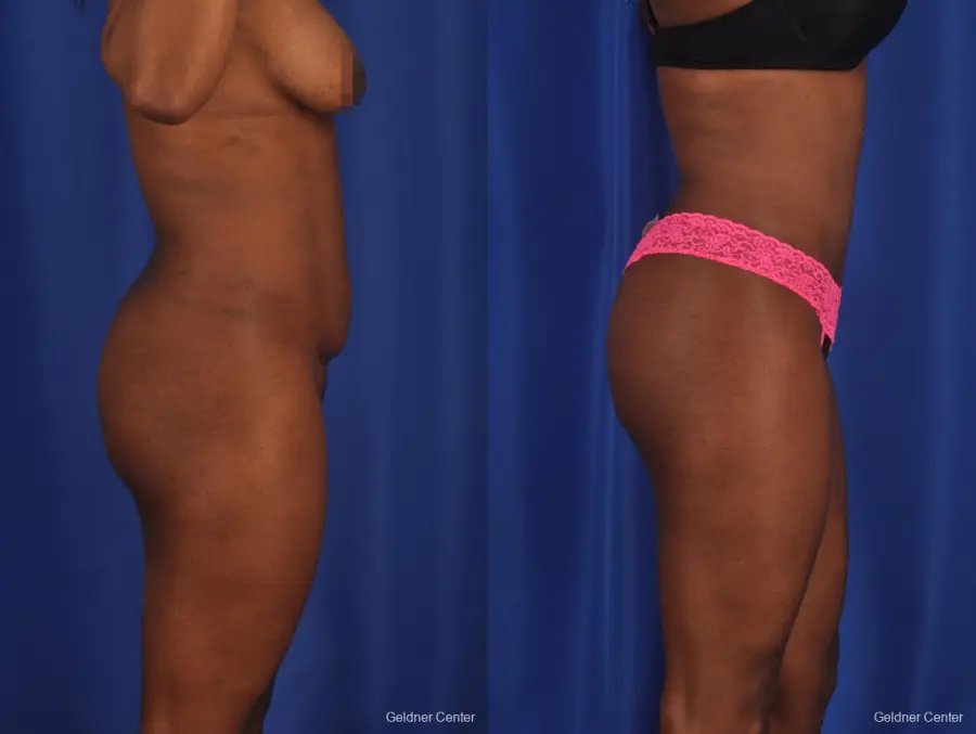 Liposuction: Patient 3 - Before and After 3