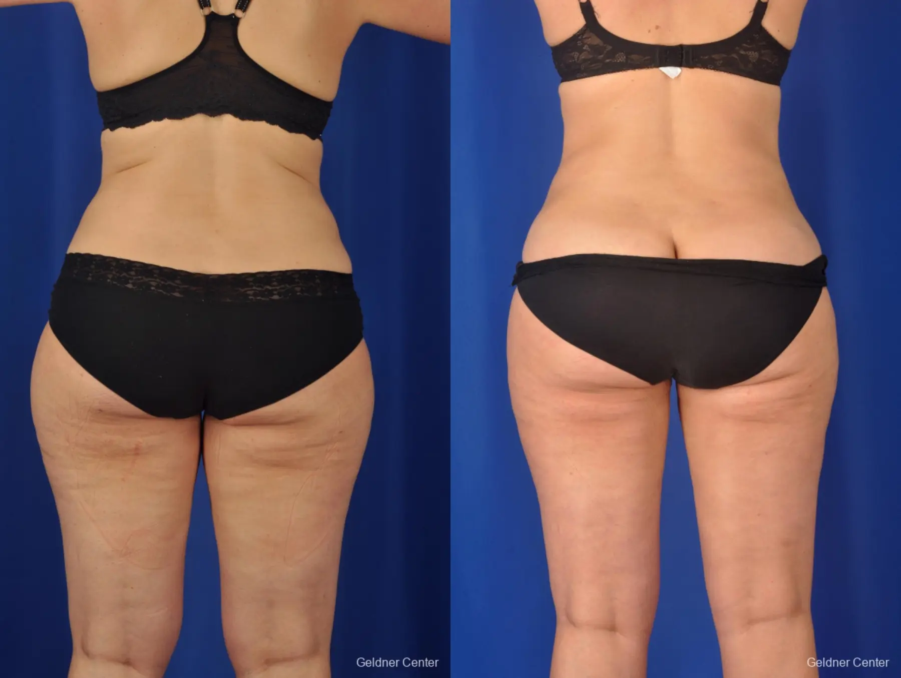 Liposuction: Patient 2 - Before and After 4