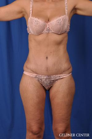 Lipoabdominoplasty: Patient 5 - After Image 1