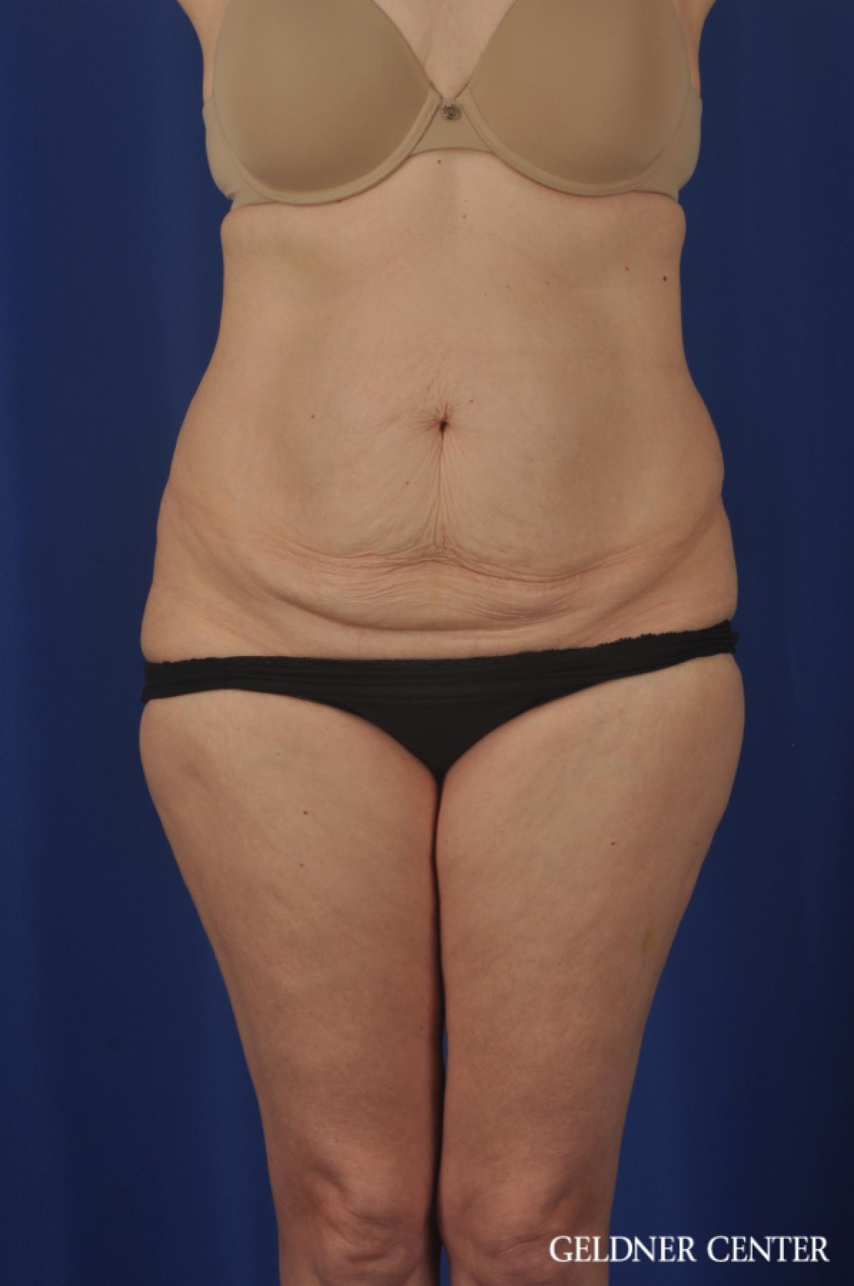 Liposuction: Patient 33 - Before 1