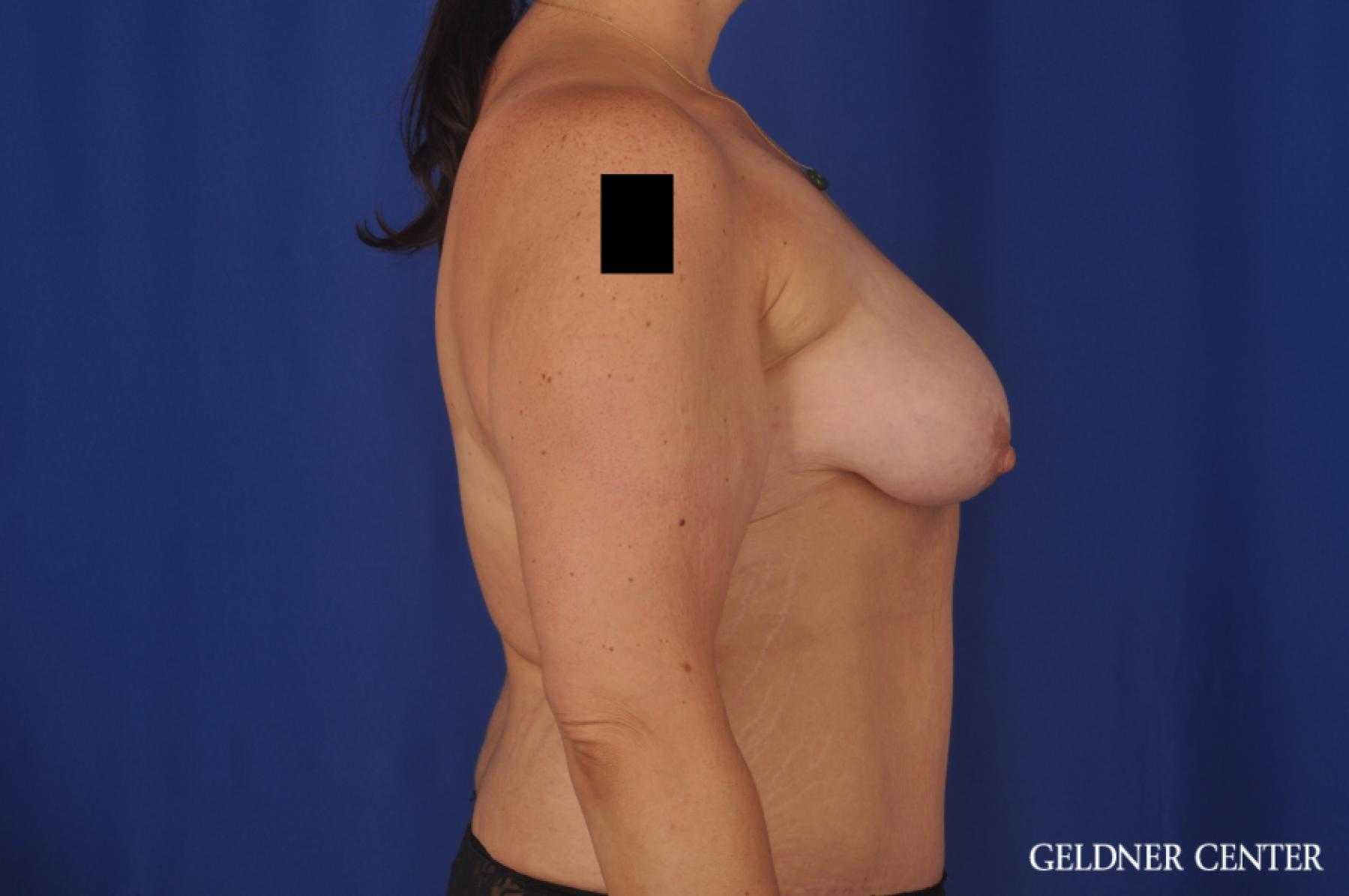 Breast Augmentation: Patient 162 - Before 3