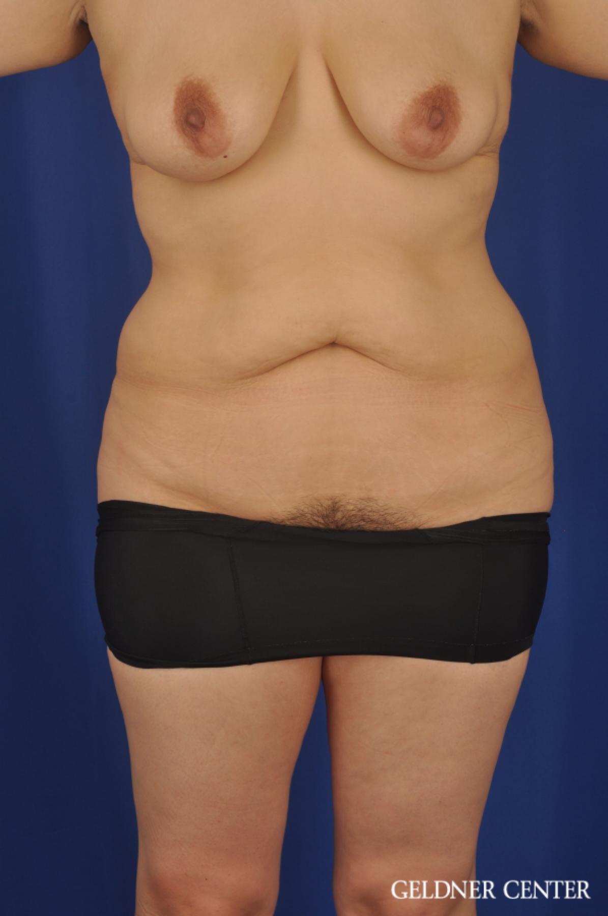 Tummy Tuck: Patient 24 - Before 