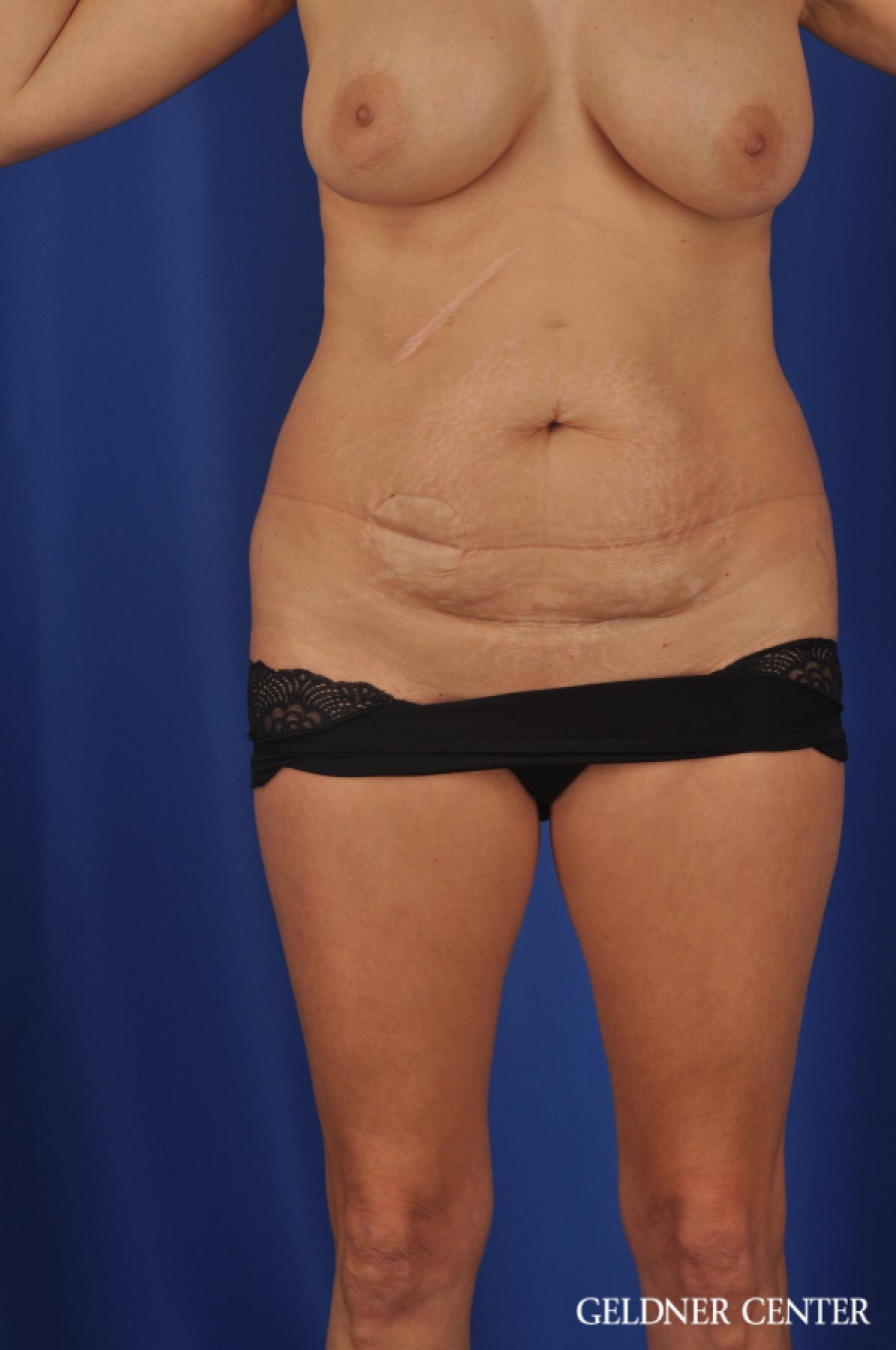 Abdominoplasty Streeterville, Chicago 11873 - Before