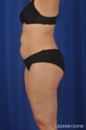 Liposuction: Patient 32 - Before 4