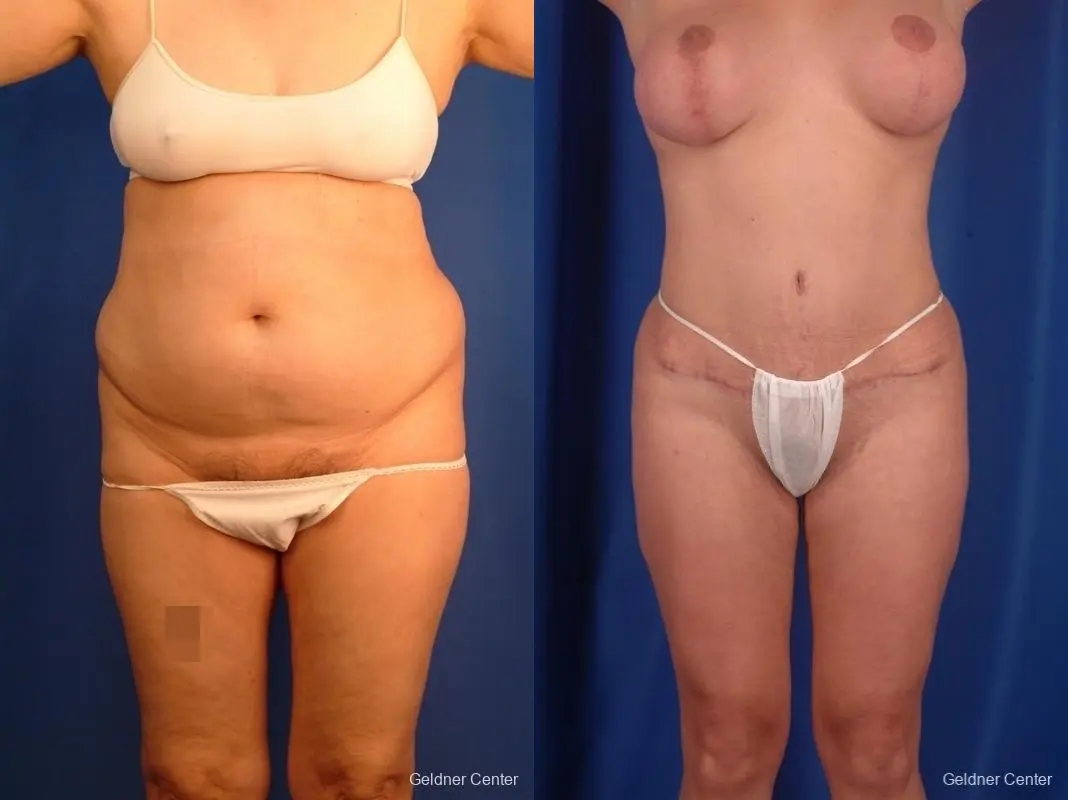 Breast Lift with Abdominoplasty - Before and After