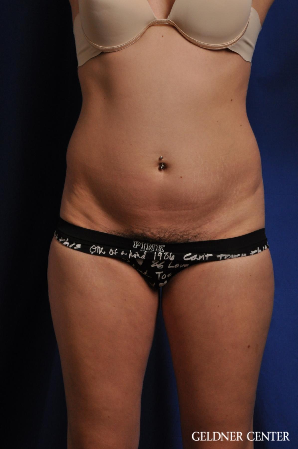 Tummy Tuck: Patient 32 - Before 1