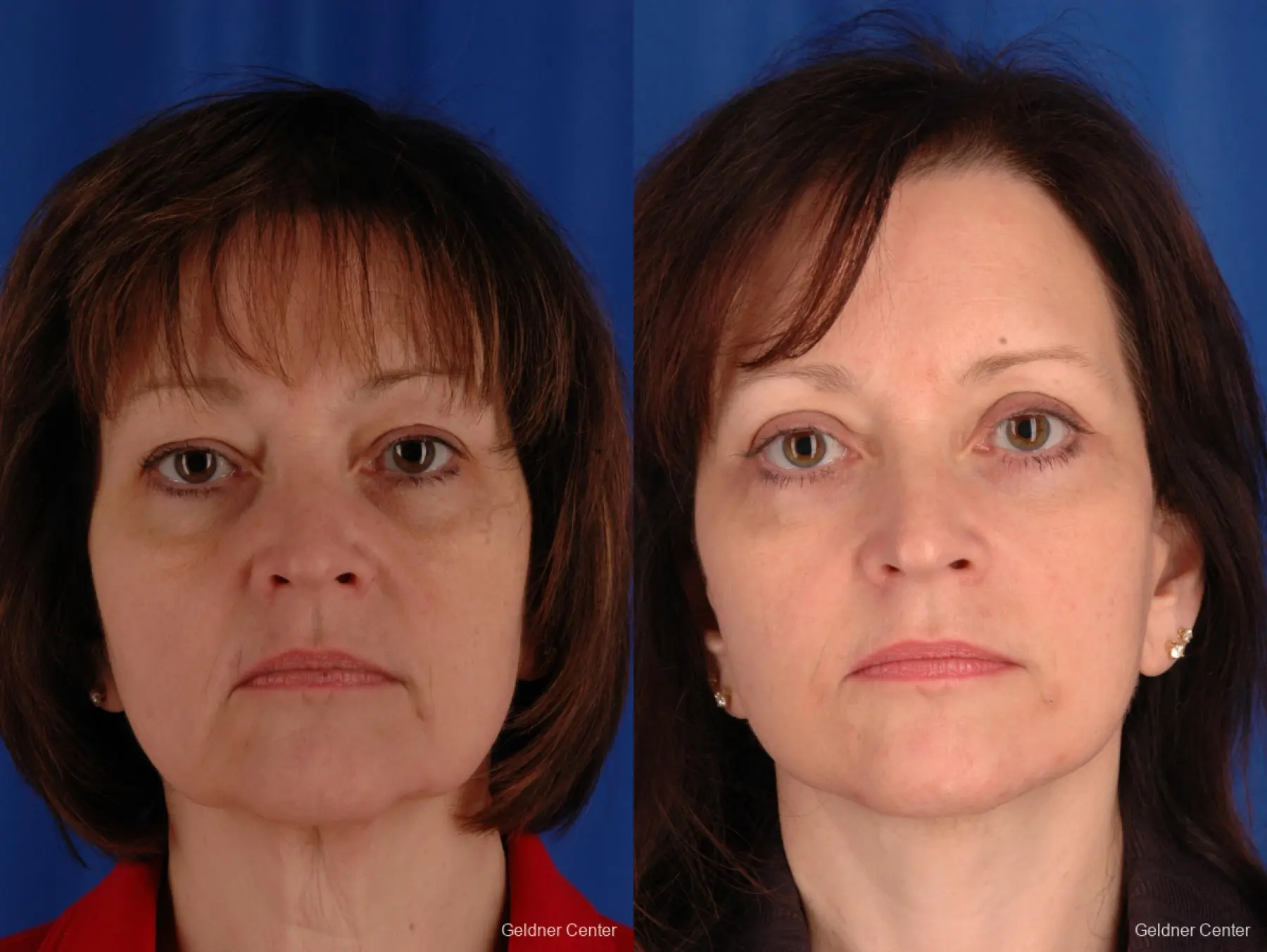 Neck Lift: Patient 2 - Before and After 1