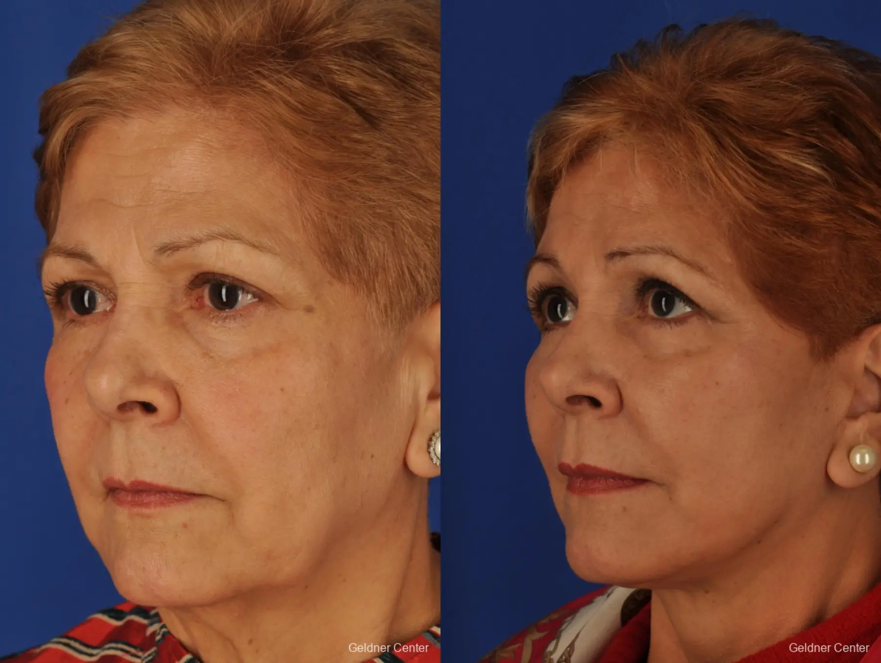 Neck Lift: Patient 1 - Before and After 4