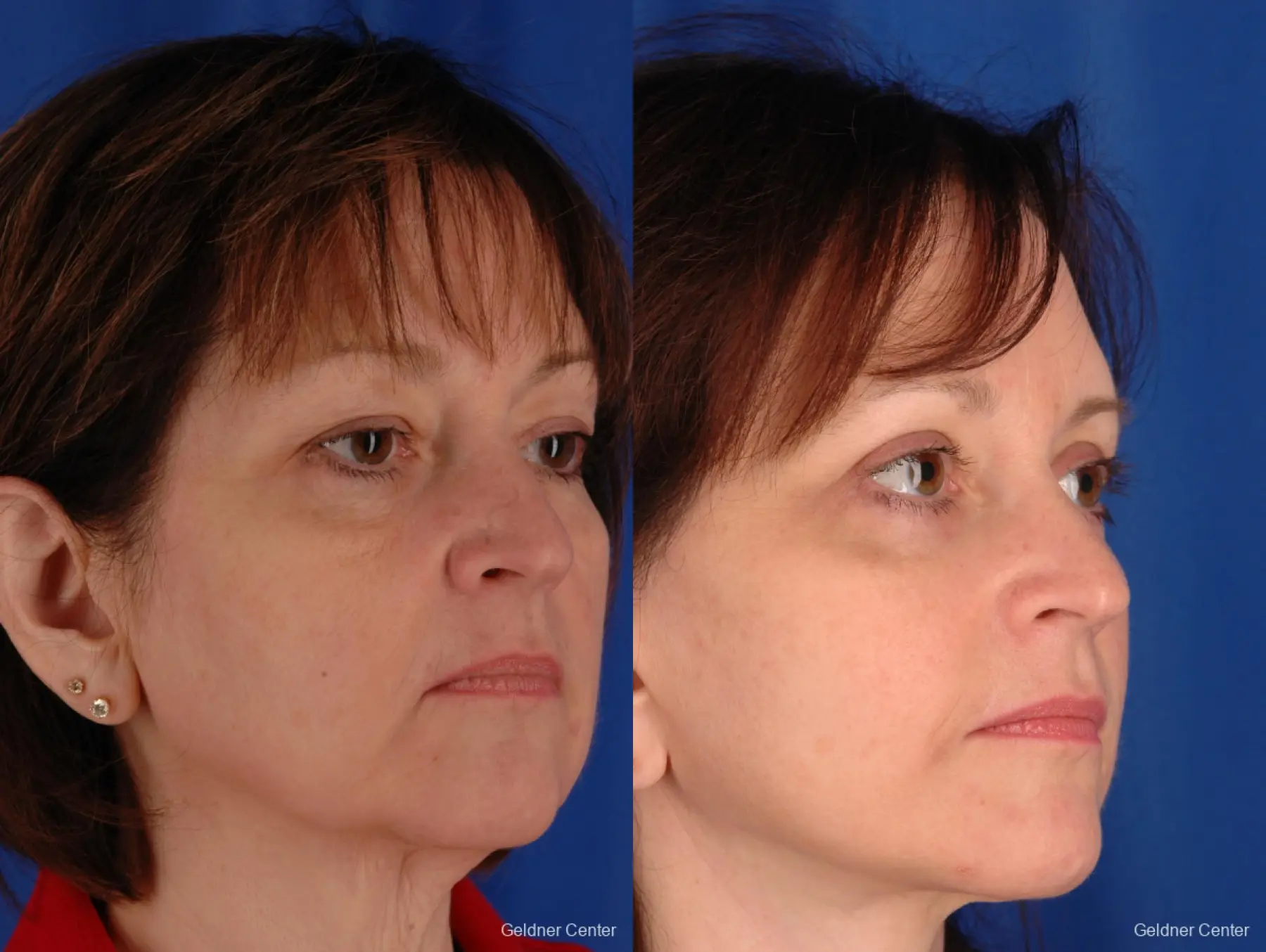 Neck Lift: Patient 2 - Before and After 3