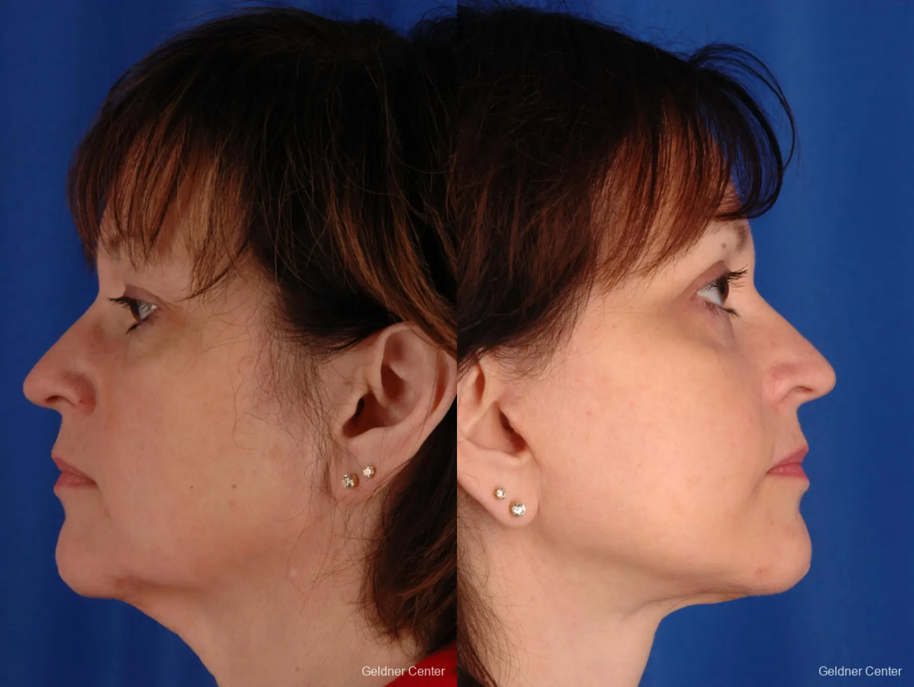 Neck Lift: Patient 2 - Before and After 2