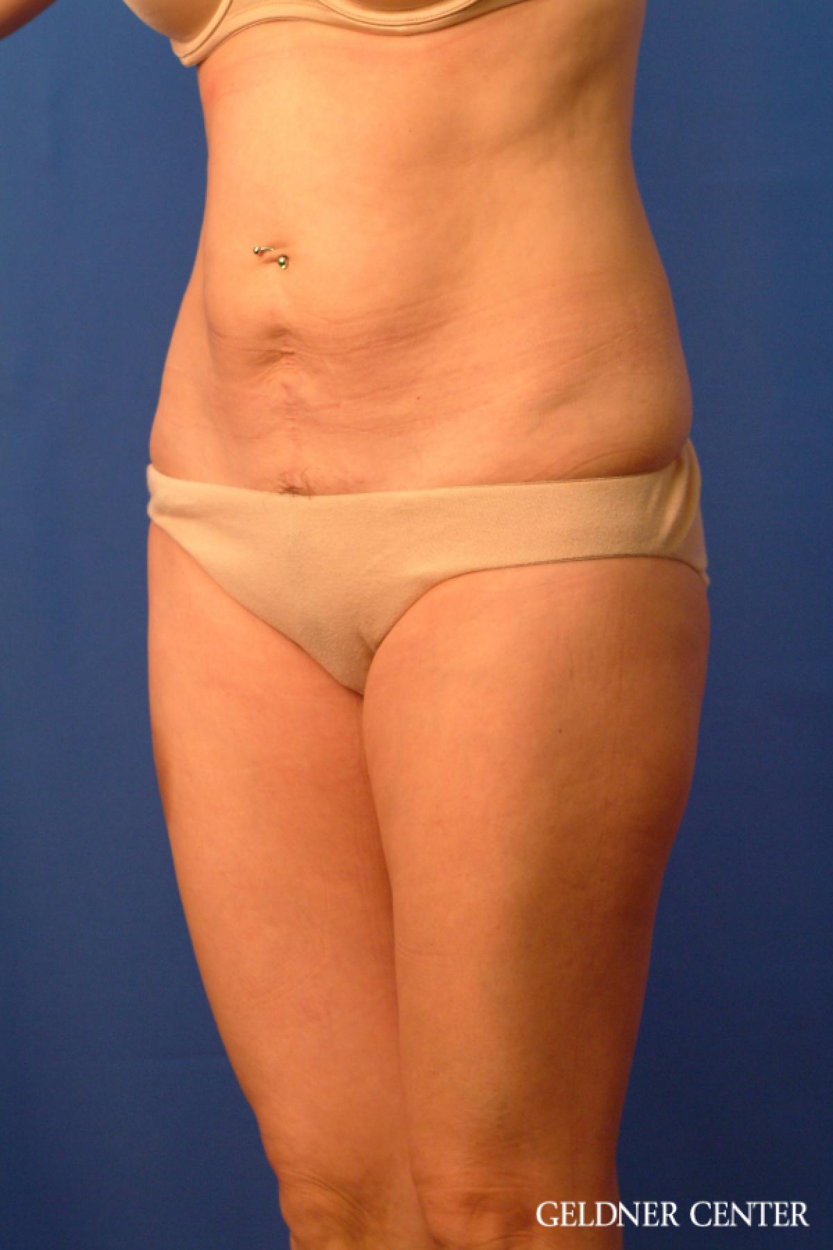 Tummy Tuck: Patient 36 - Before and After 4