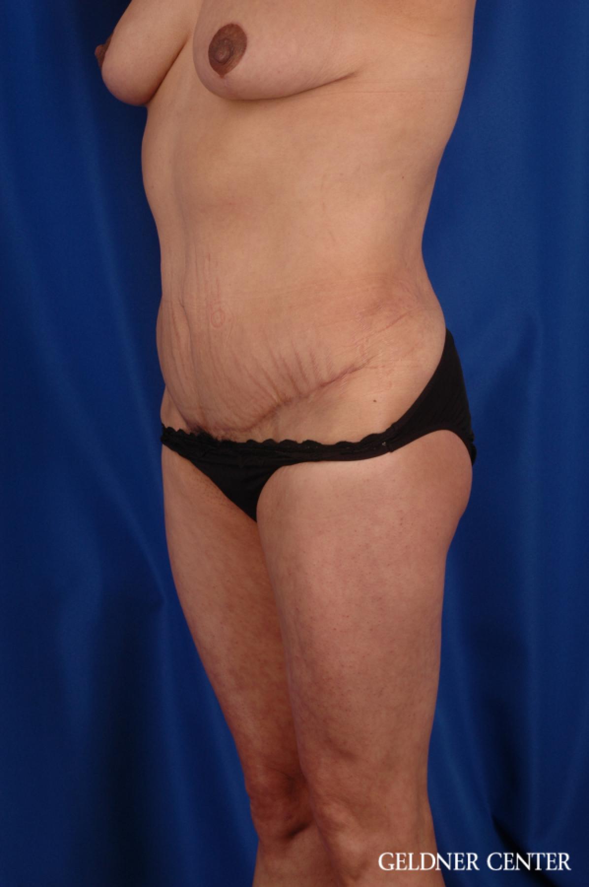 Tummy Tuck: Patient 16 - After 5