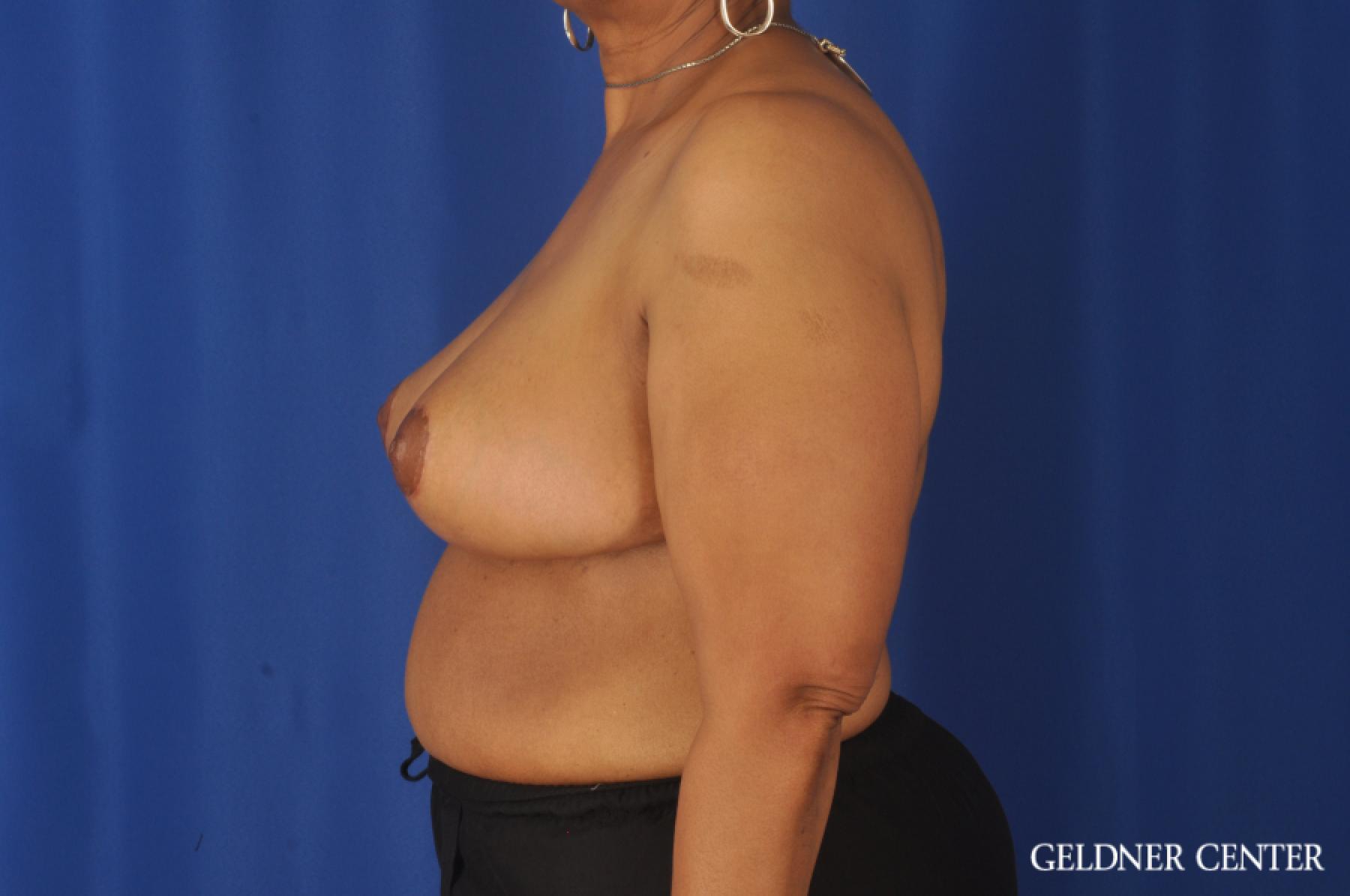 Breast Reduction: Patient 25 - After 5