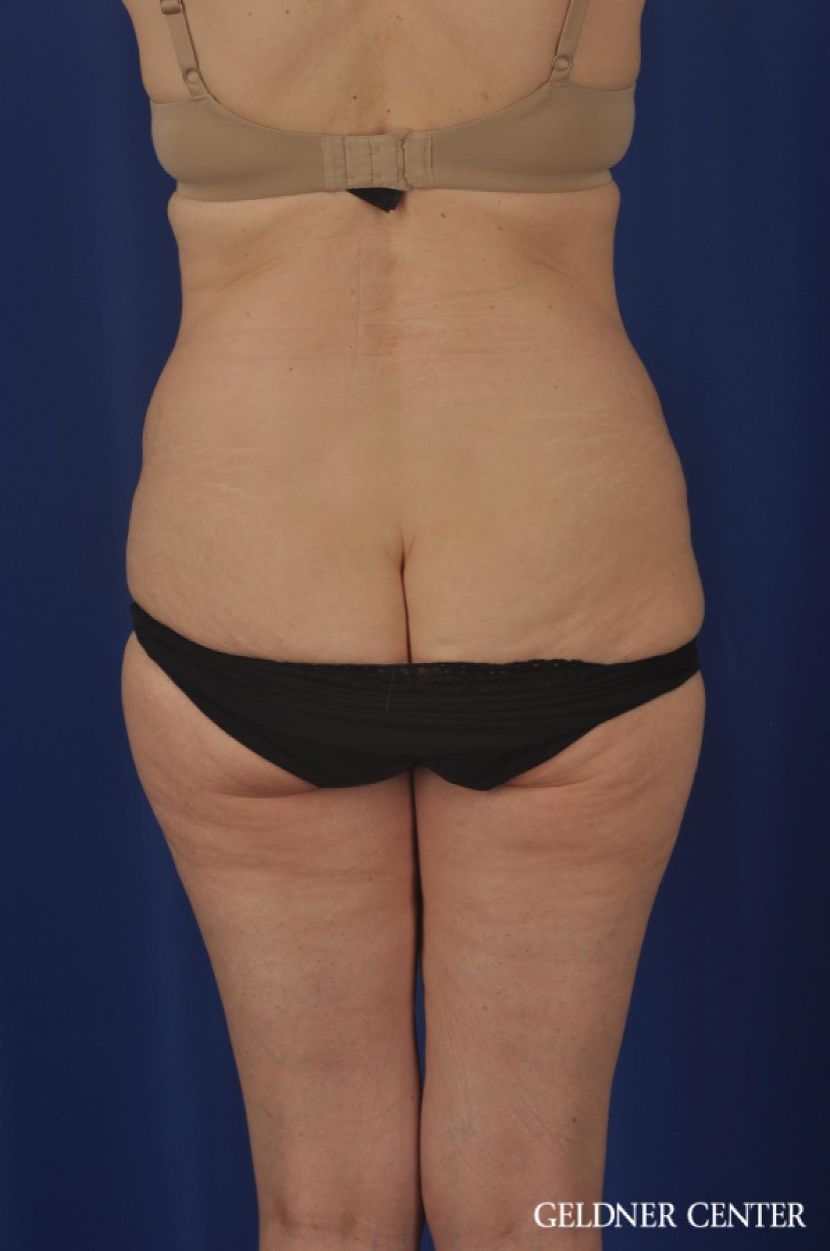 Liposuction: Patient 33 - Before 4