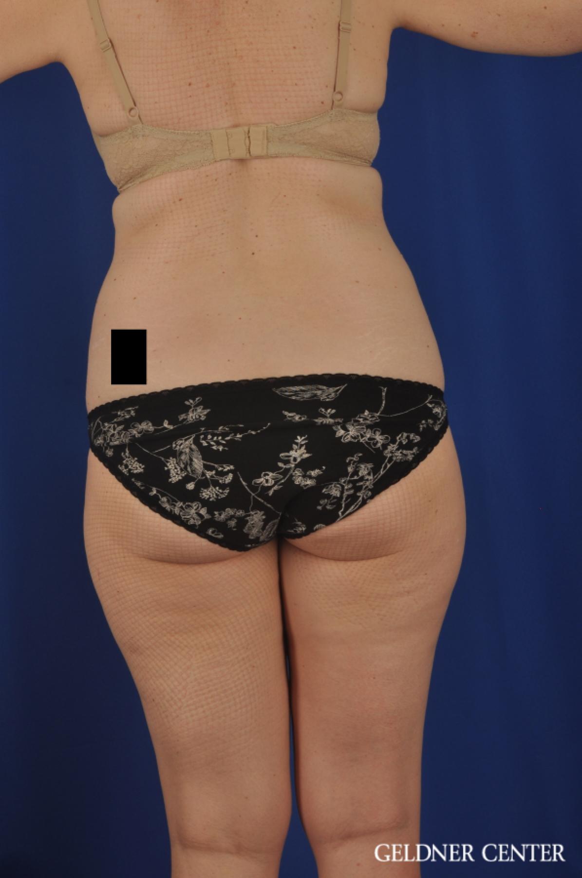 Tummy Tuck: Patient 22 - Before 4