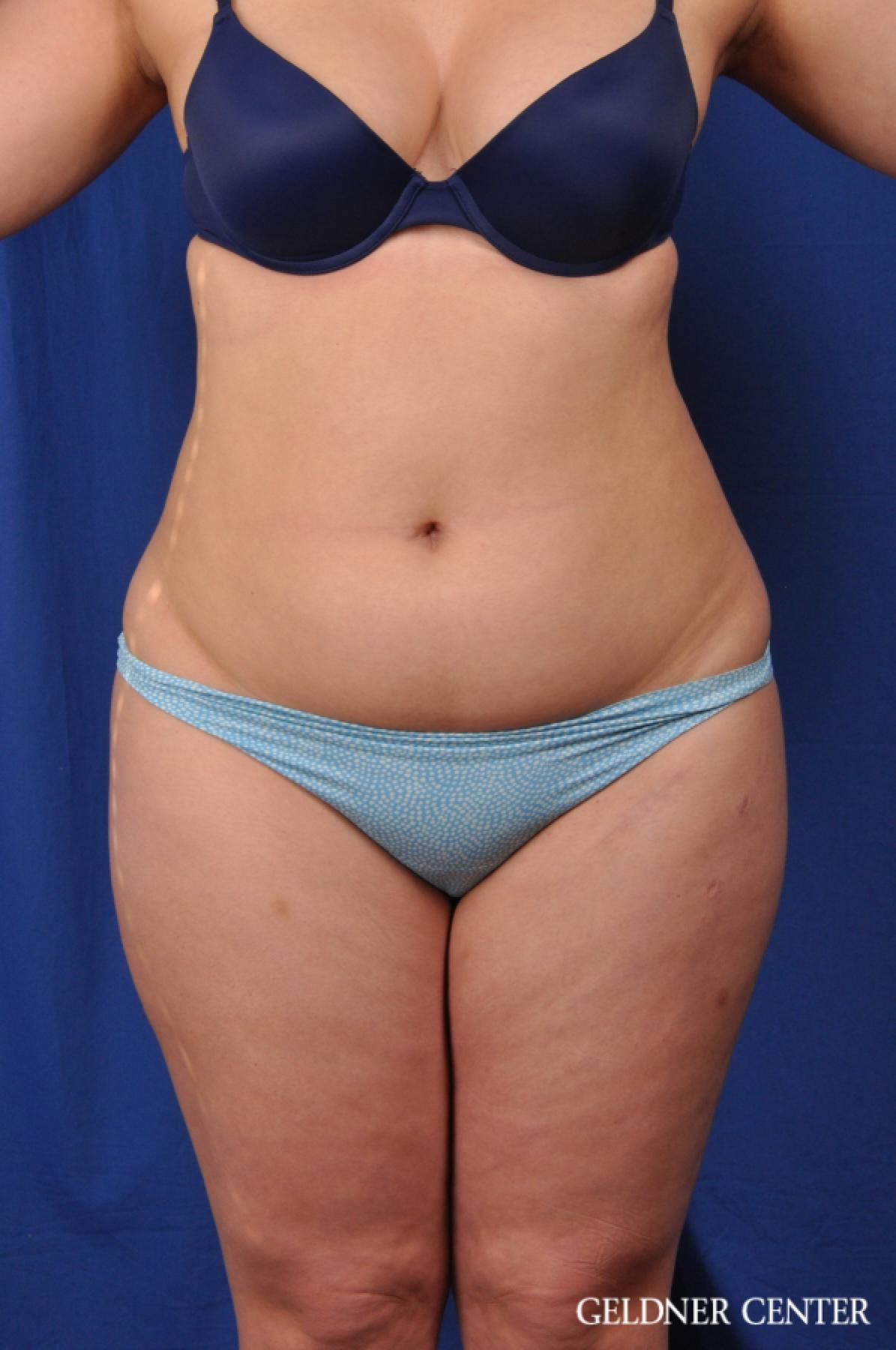 VASER® Lipo: Patient 10 - Before 