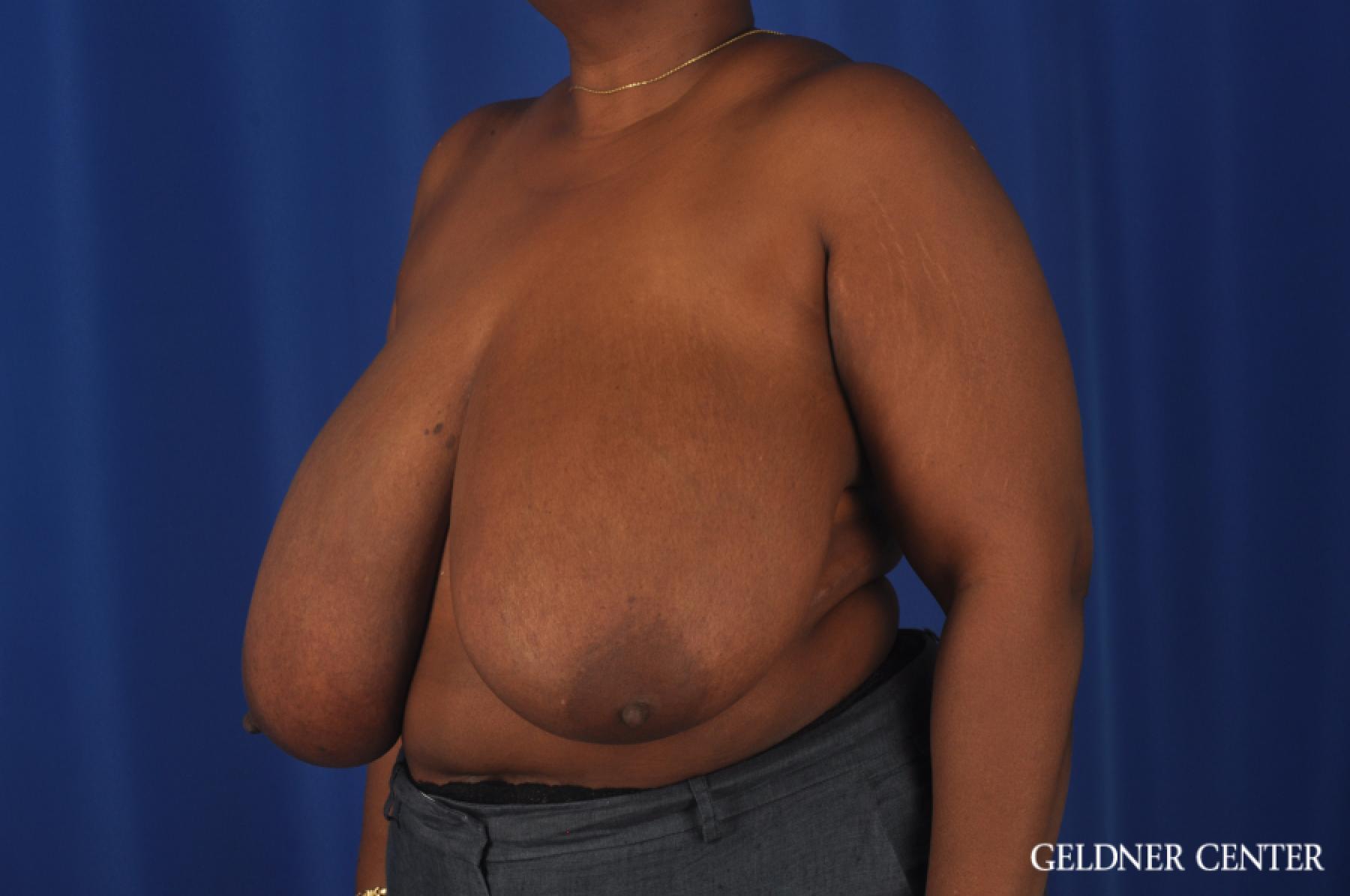 Chicago Breast Reduction 11871 - Before and After 4