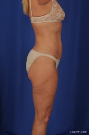 Lipoabdominoplasty: Patient 2 - After Image 3