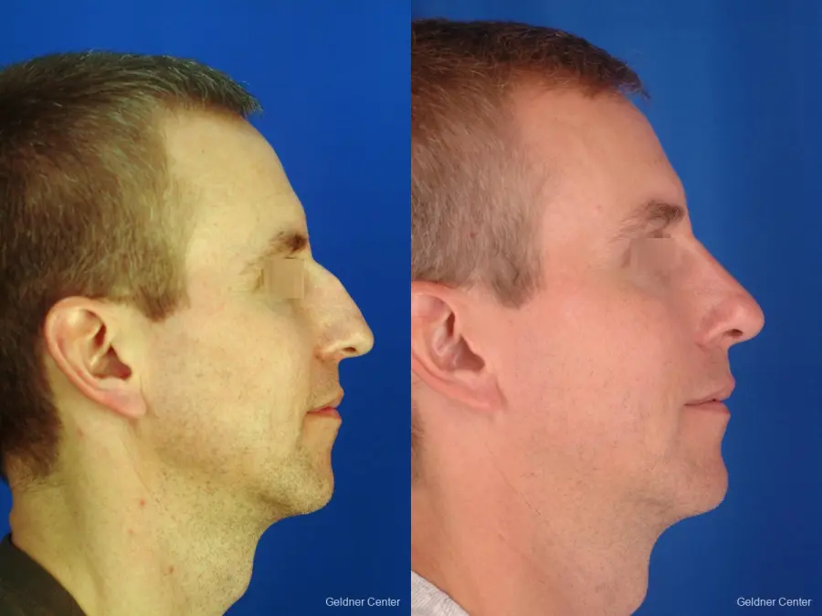 Rhinoplasty For Men: Patient 1 - Before and After 3