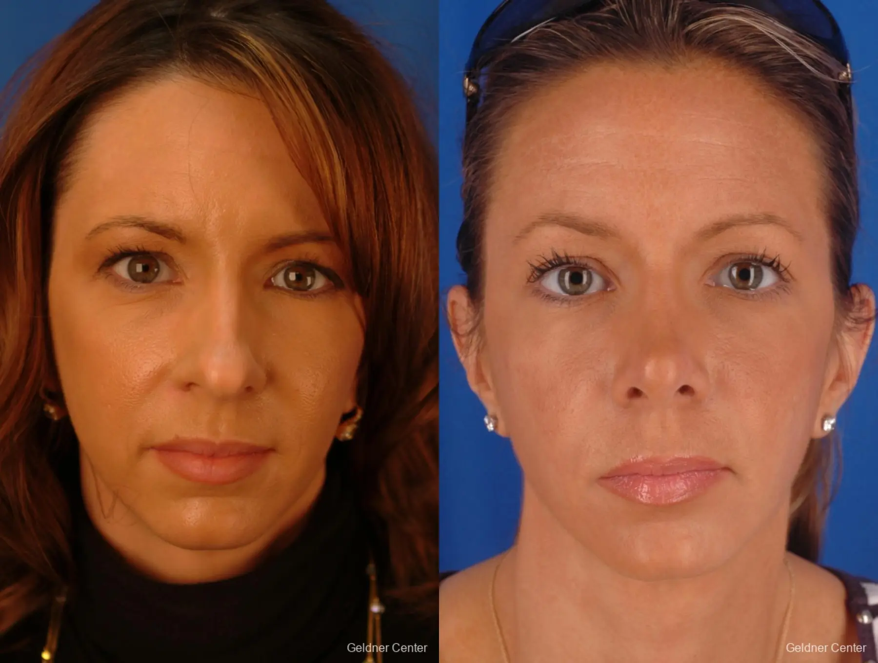 Rhinoplasty: Patient 2 - Before and After  