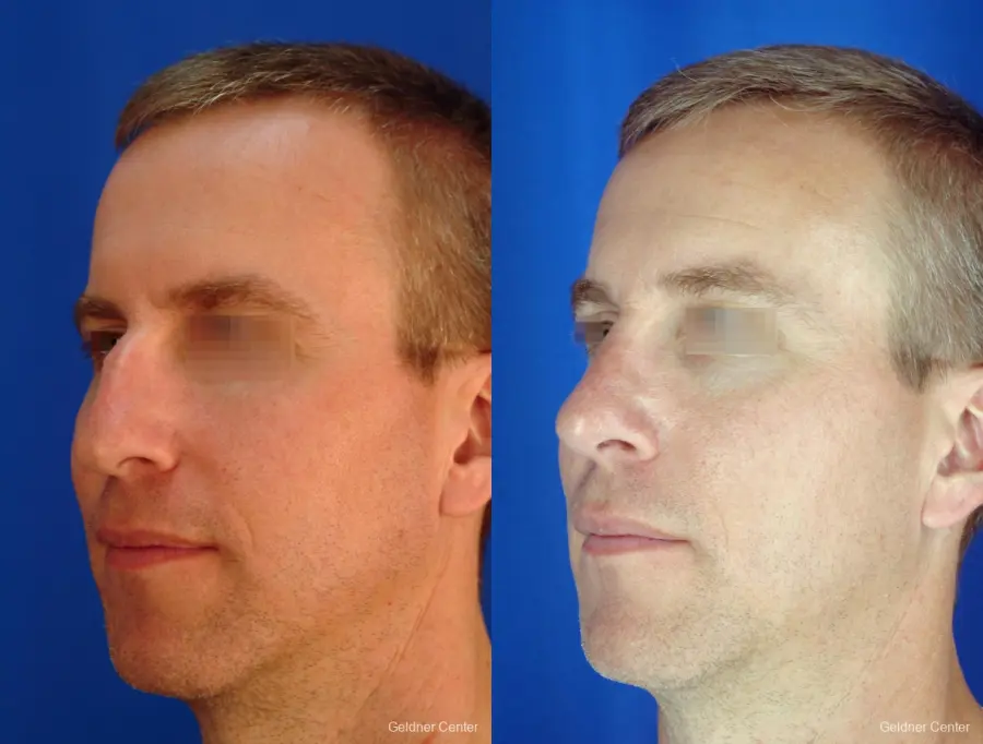 Rhinoplasty For Men: Patient 1 - Before and After 4