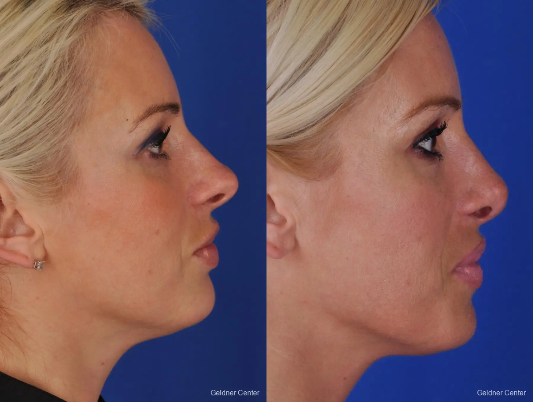 Chicago Rhinoplasty - Before and After 2