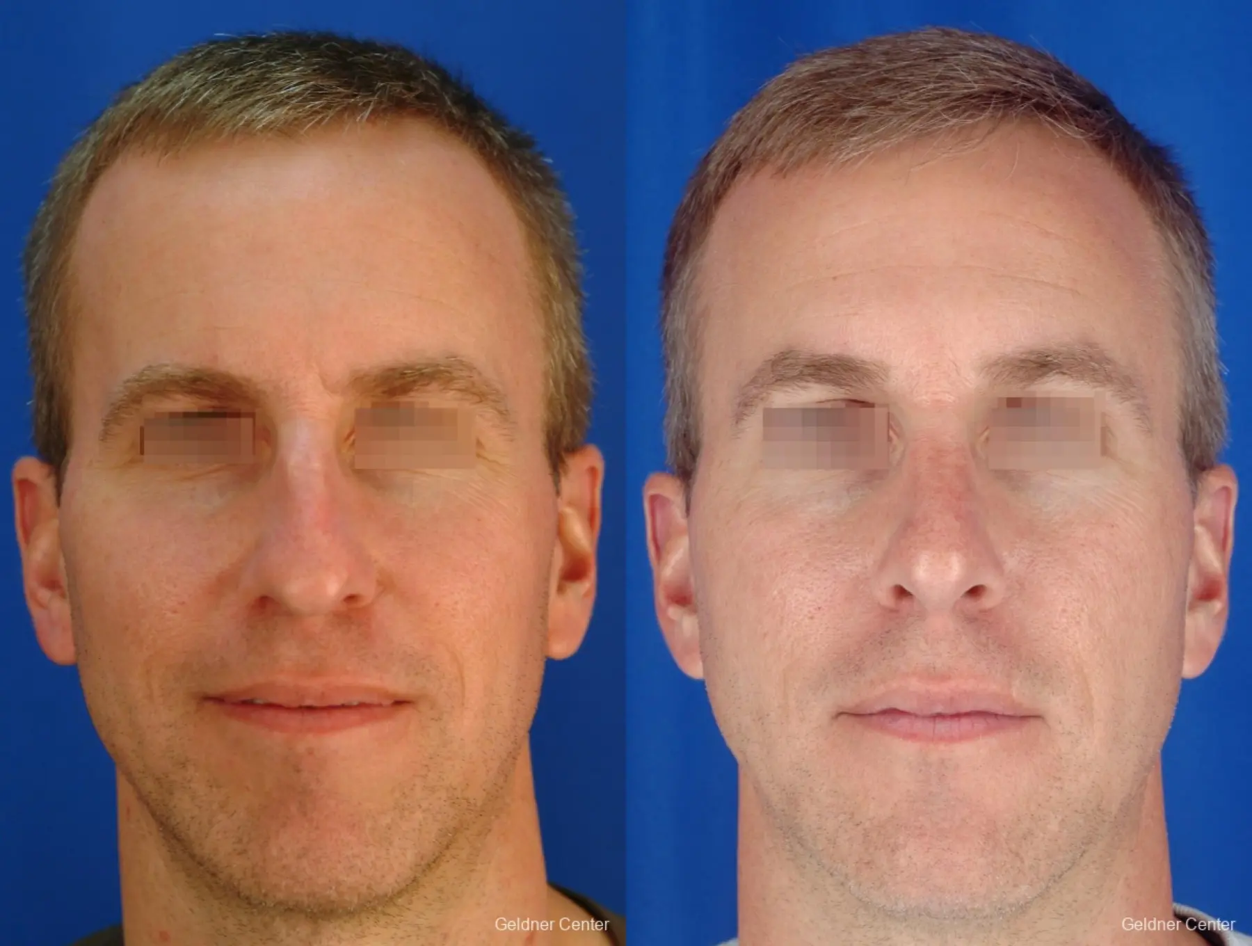 Rhinoplasty-for-men: Patient 1 - Before and After  