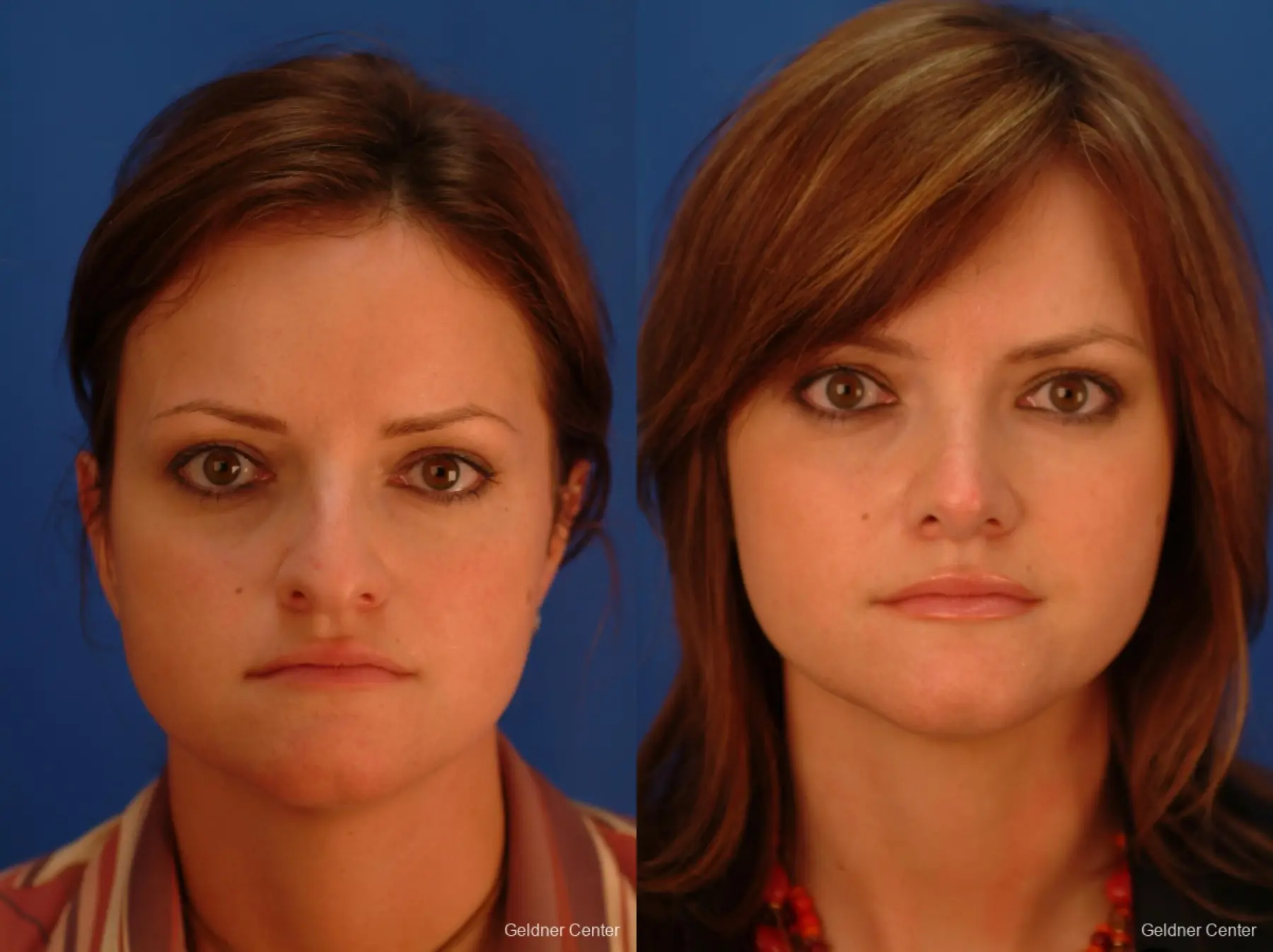 Rhinoplasty: Patient 1 - Before and After  