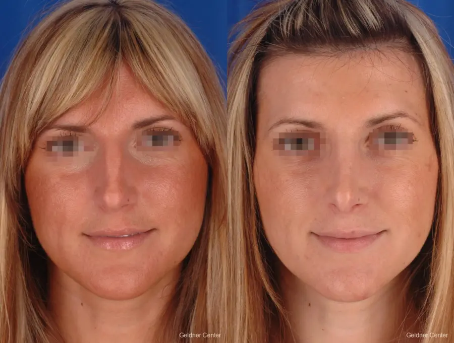 Rhinoplasty: Patient 3 - Before and After  